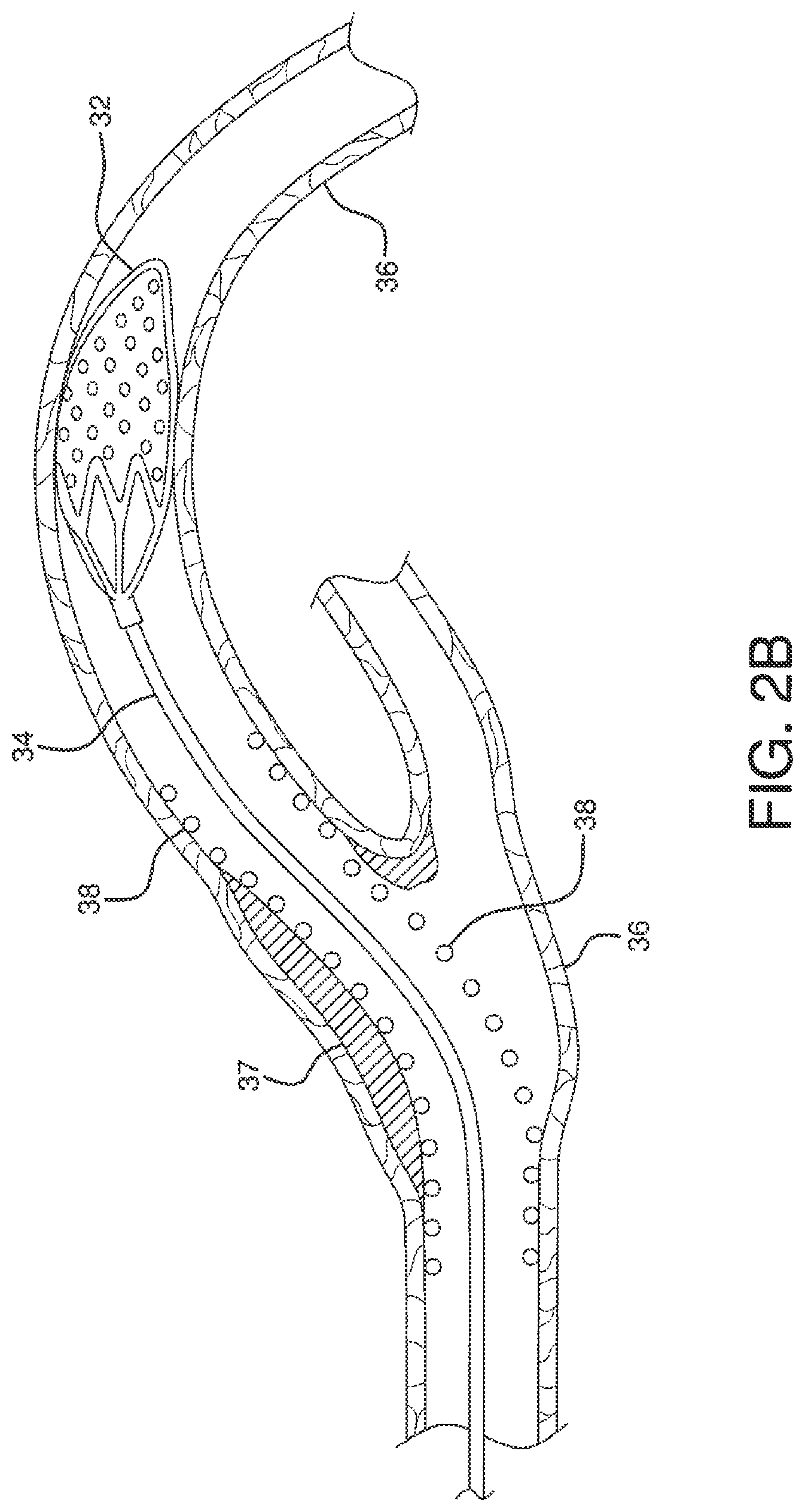 Patent US12551326 Figure 7 – Retrieval catheter