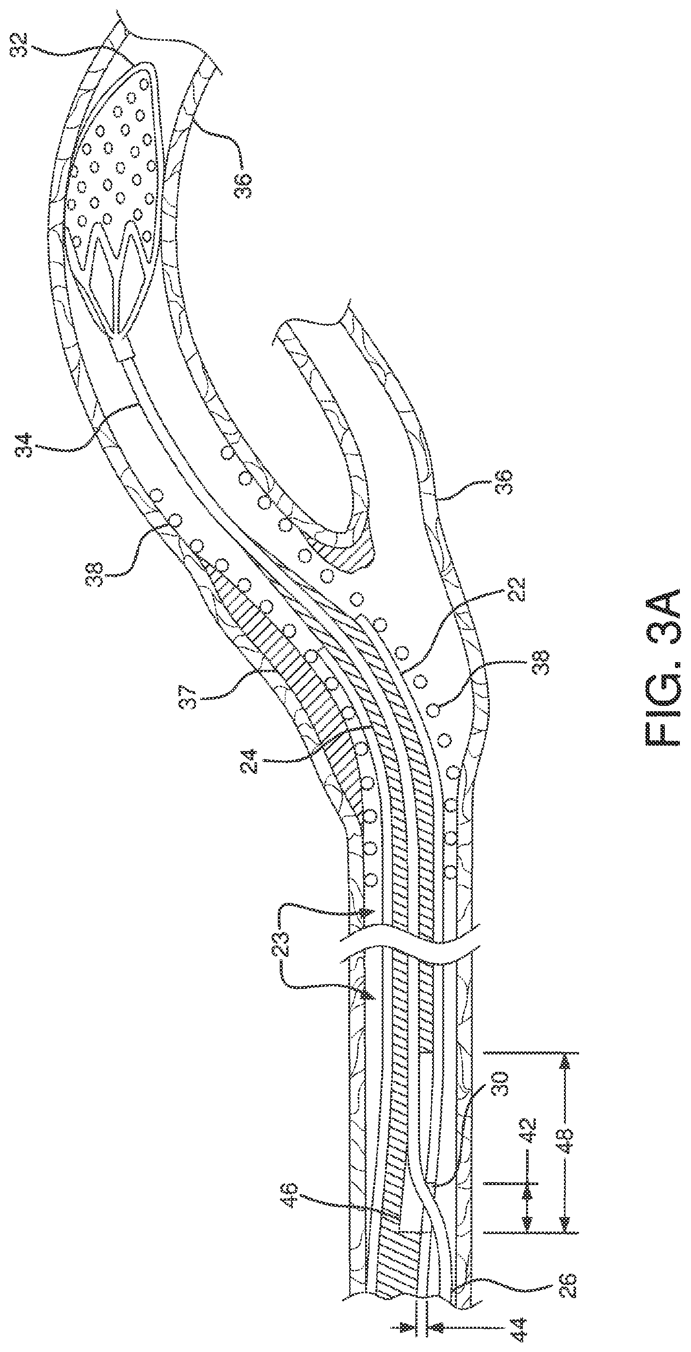 Patent US12551326 Figure 9 – Retrieval catheter
