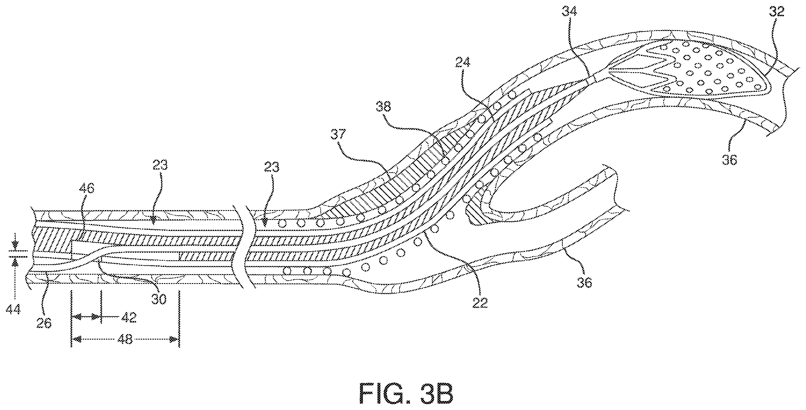 Patent US12551326 Figure 10 – Retrieval catheter