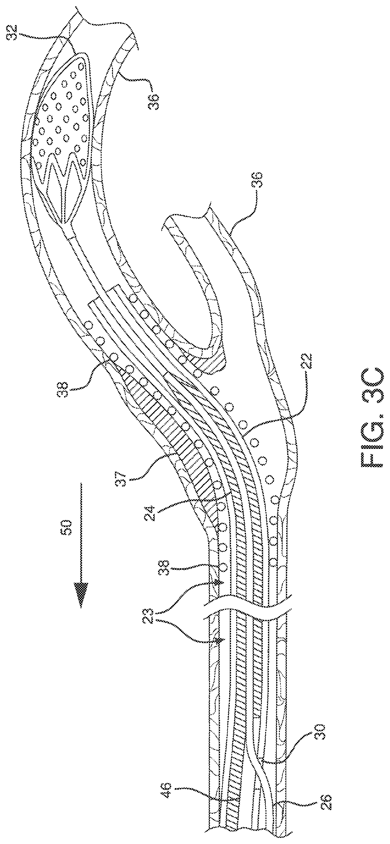 Patent US12551326 Figure 11 – Retrieval catheter