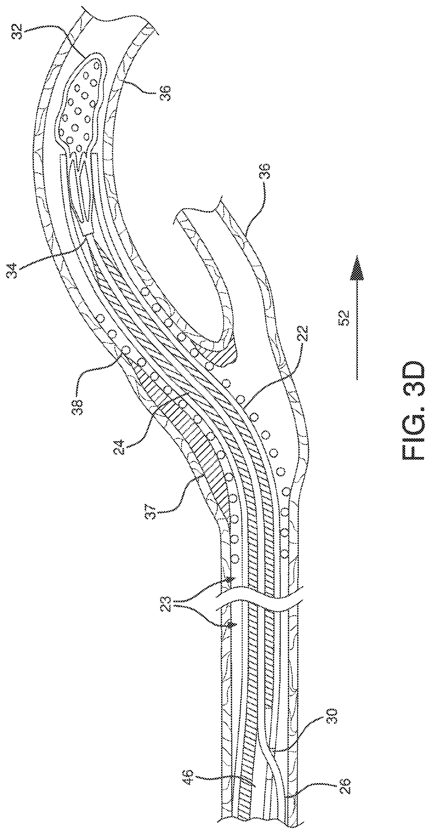 Patent US12551326 Figure 12 – Retrieval catheter