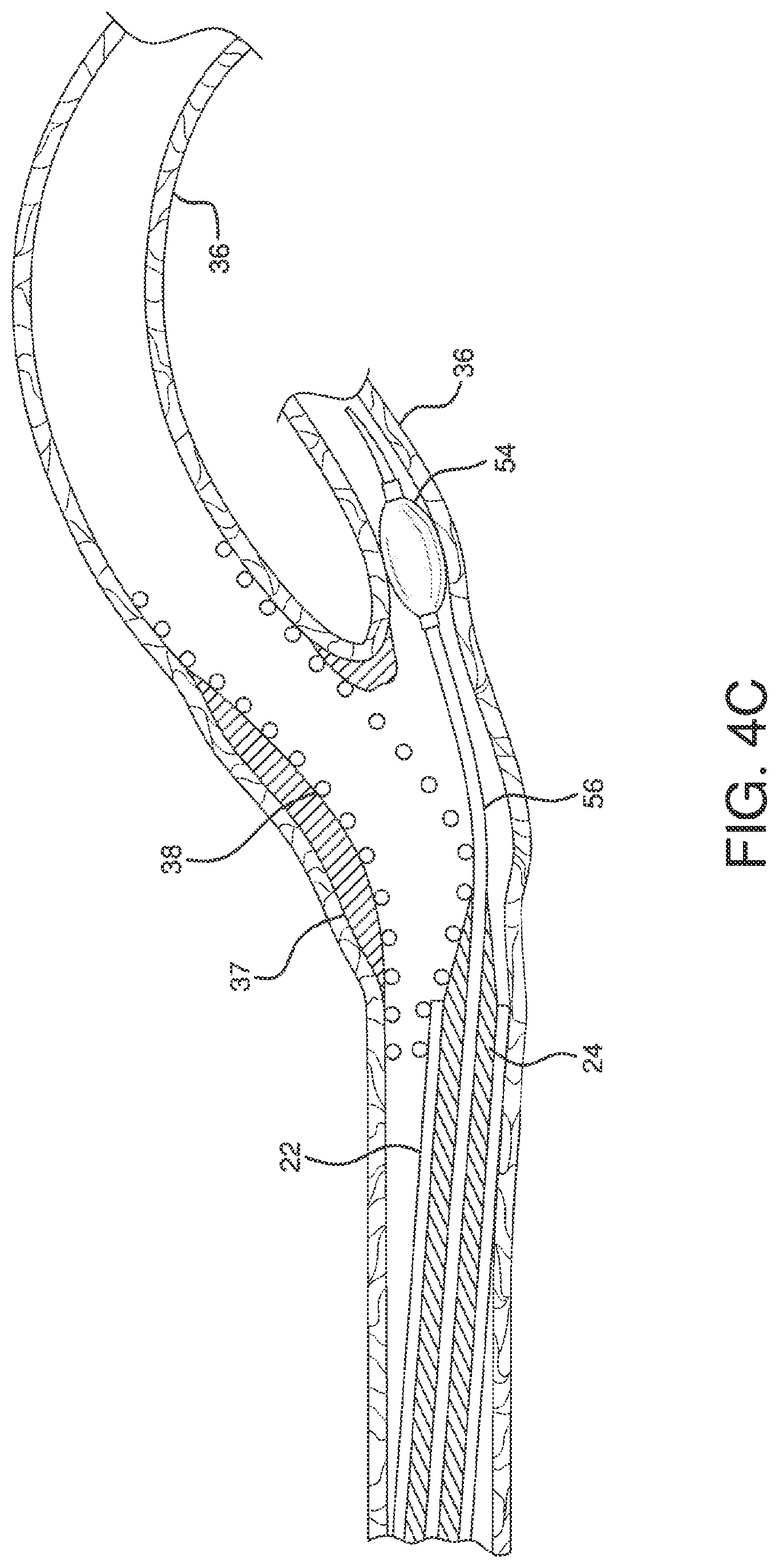 Patent US12551326 Figure 15 – Retrieval catheter