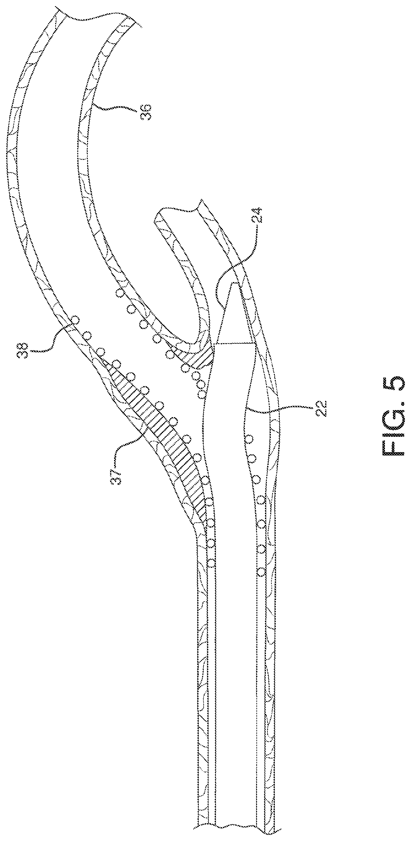 Patent US12551326 Figure 16 – Retrieval catheter