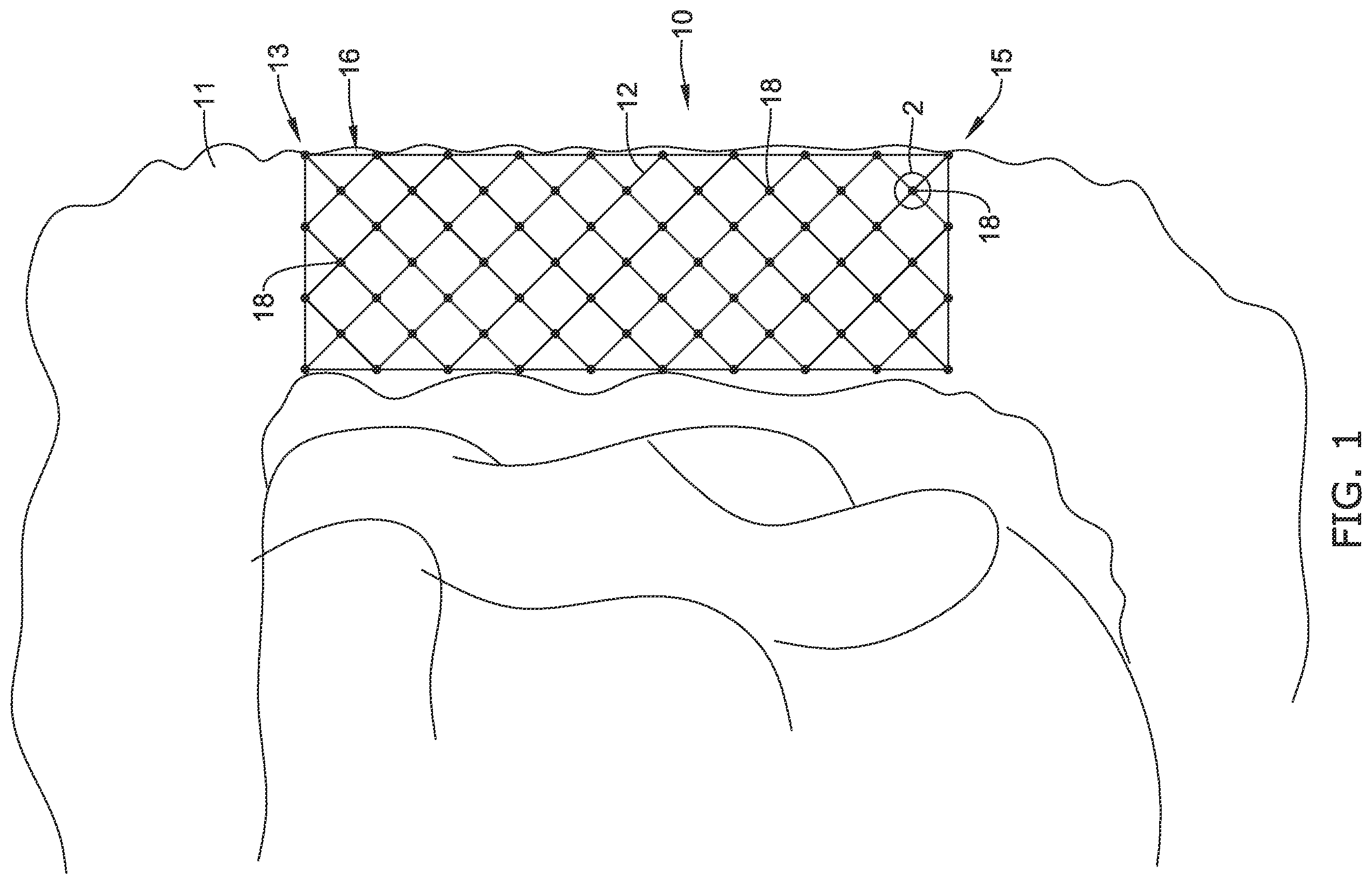 Patent US12551327 Figure 1 – Biodegradable stent