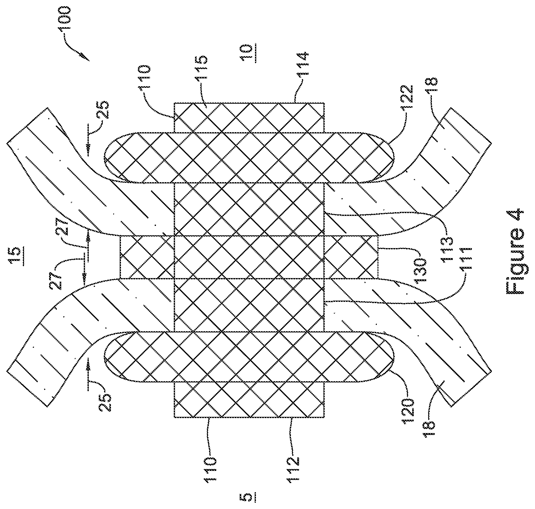Patent US12551328 Figure 4 – Device for anastomotic bypass
