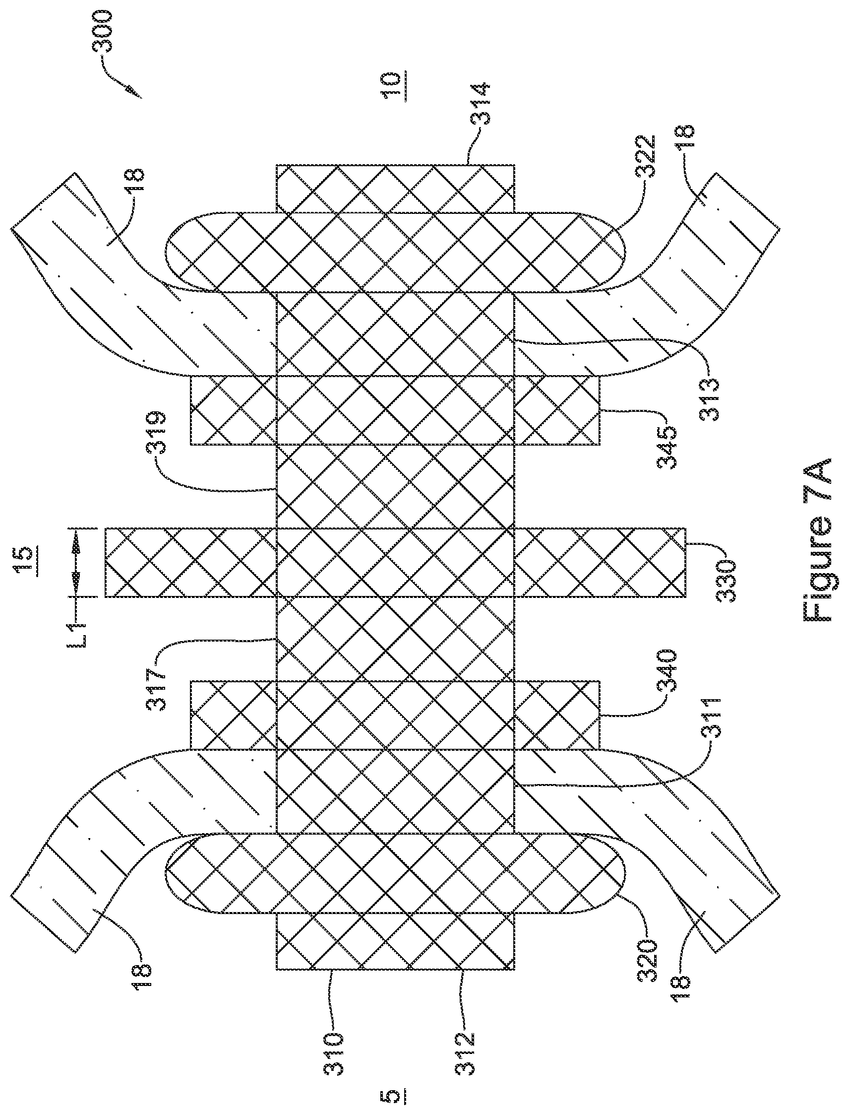 Patent US12551328 Figure 7 – Device for anastomotic bypass