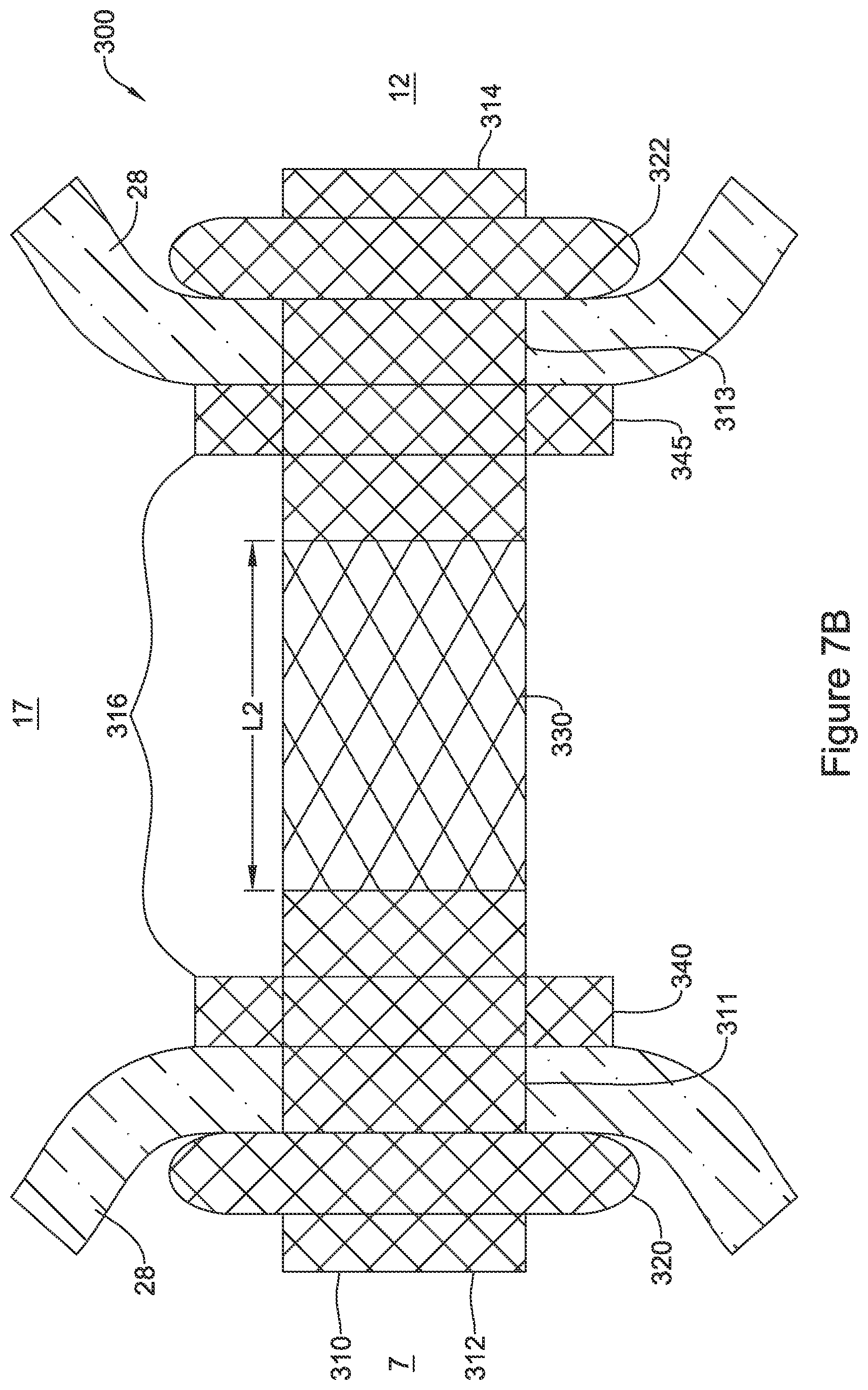 Patent US12551328 Figure 8 – Device for anastomotic bypass
