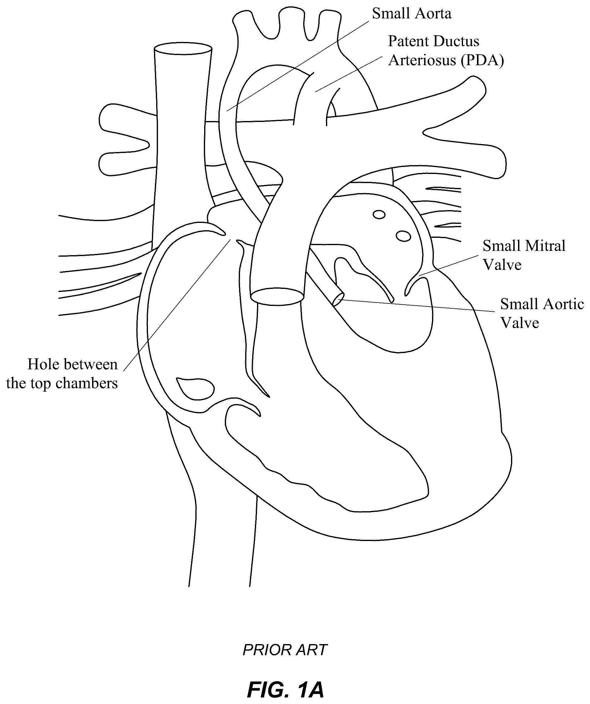 Patent US12551329 Figure 1 – Transcatheter growth devices and methods for Norwood, Glenn and Fontan therapy