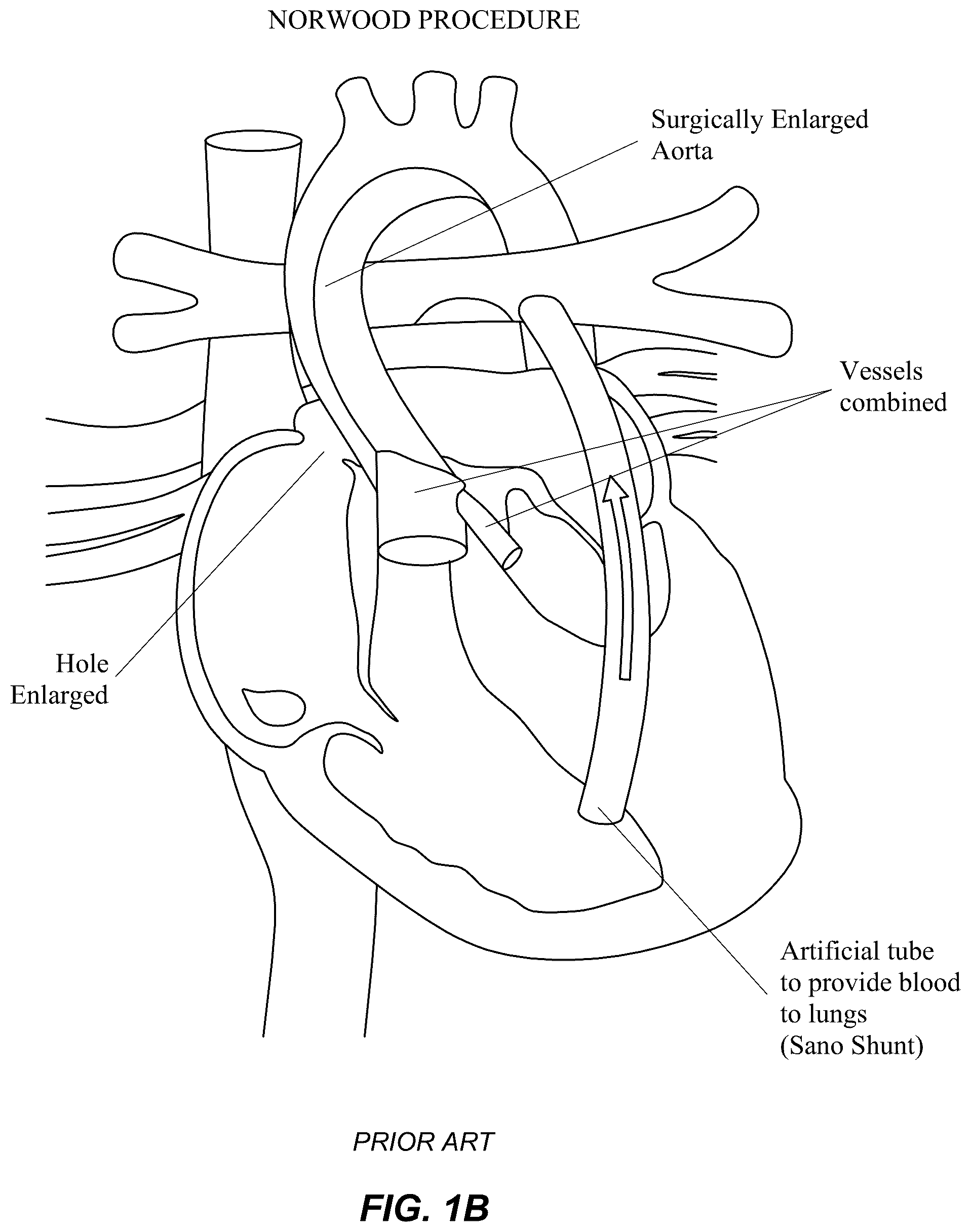 Patent US12551329 Figure 2 – Transcatheter growth devices and methods for Norwood, Glenn and Fontan therapy
