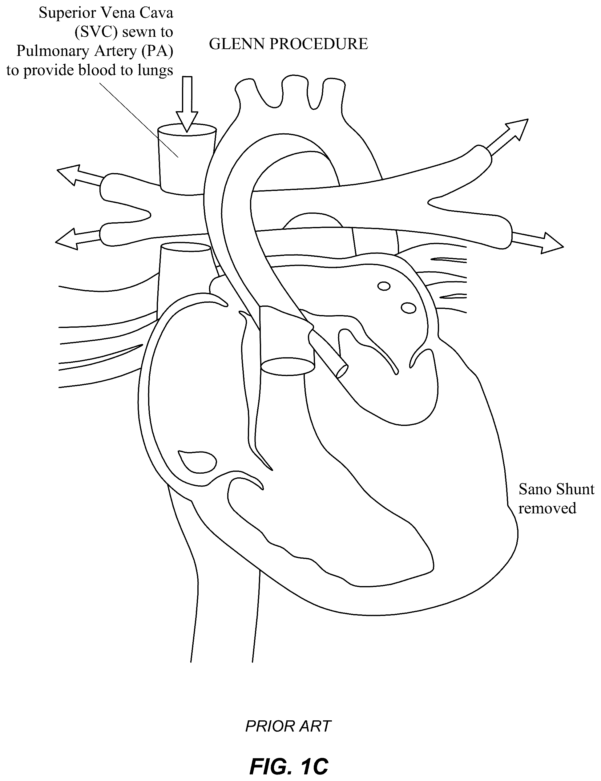 Patent US12551329 Figure 3 – Transcatheter growth devices and methods for Norwood, Glenn and Fontan therapy