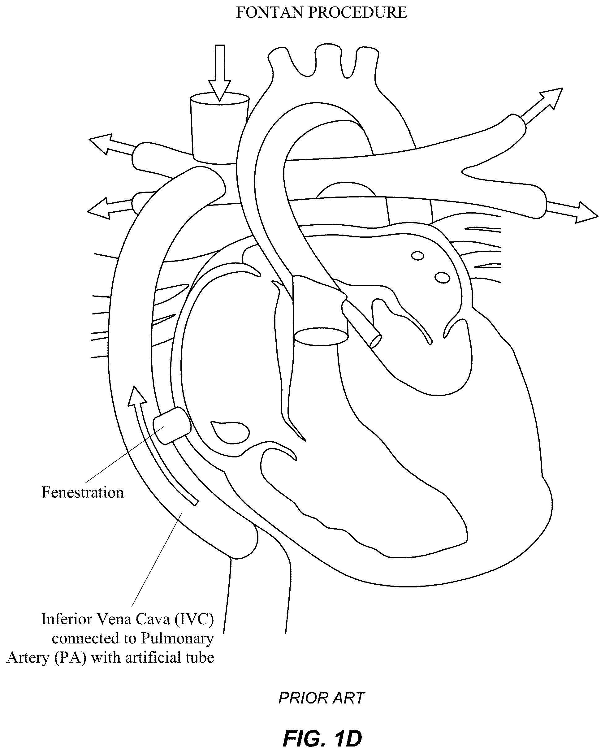 Patent US12551329 Figure 4 – Transcatheter growth devices and methods for Norwood, Glenn and Fontan therapy