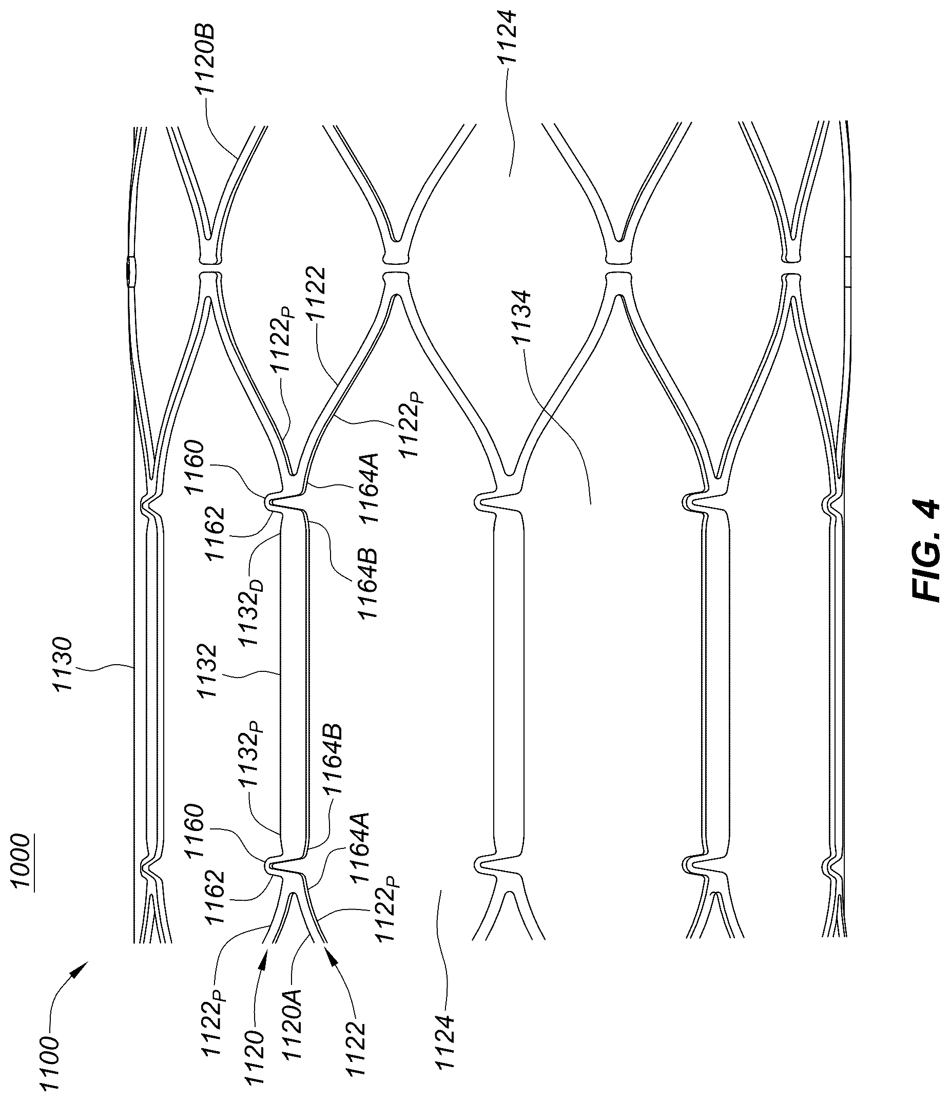Patent US12551329 Figure 11 – Transcatheter growth devices and methods for Norwood, Glenn and Fontan therapy