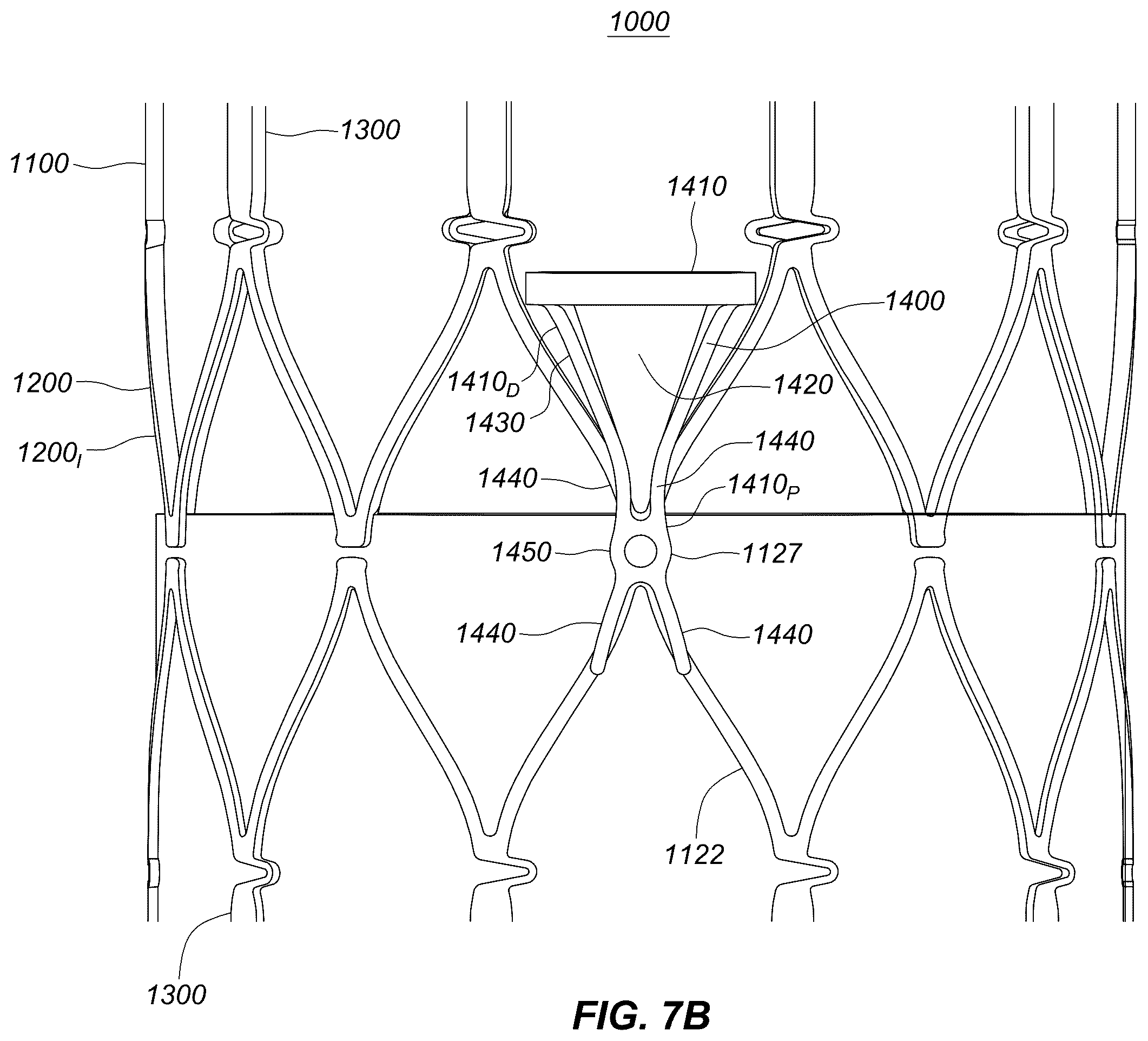 Patent US12551329 Figure 20 – Transcatheter growth devices and methods for Norwood, Glenn and Fontan therapy