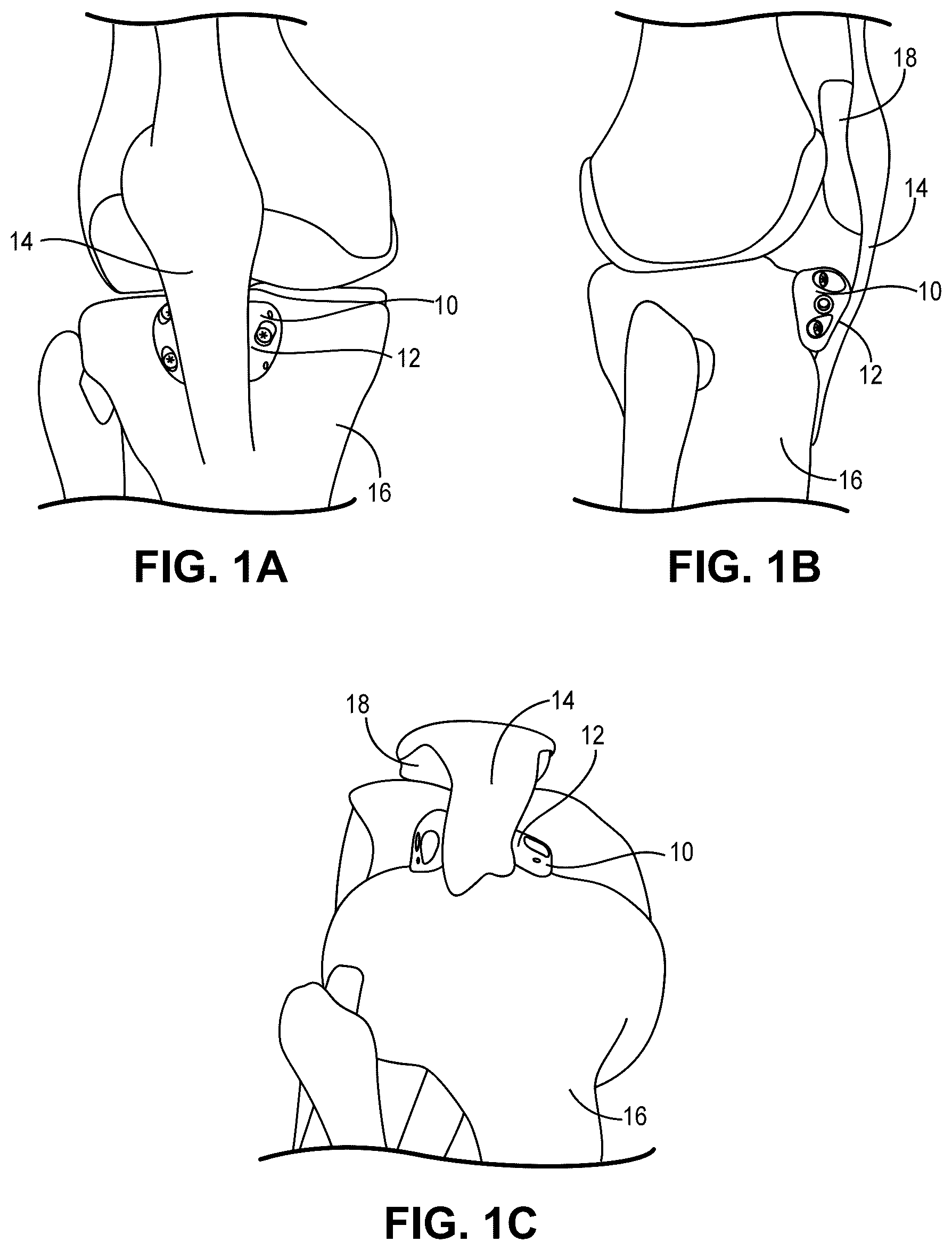 Patent US12551330 Figure 1 – Multiplanar tendon realignment implants and related systems and methods