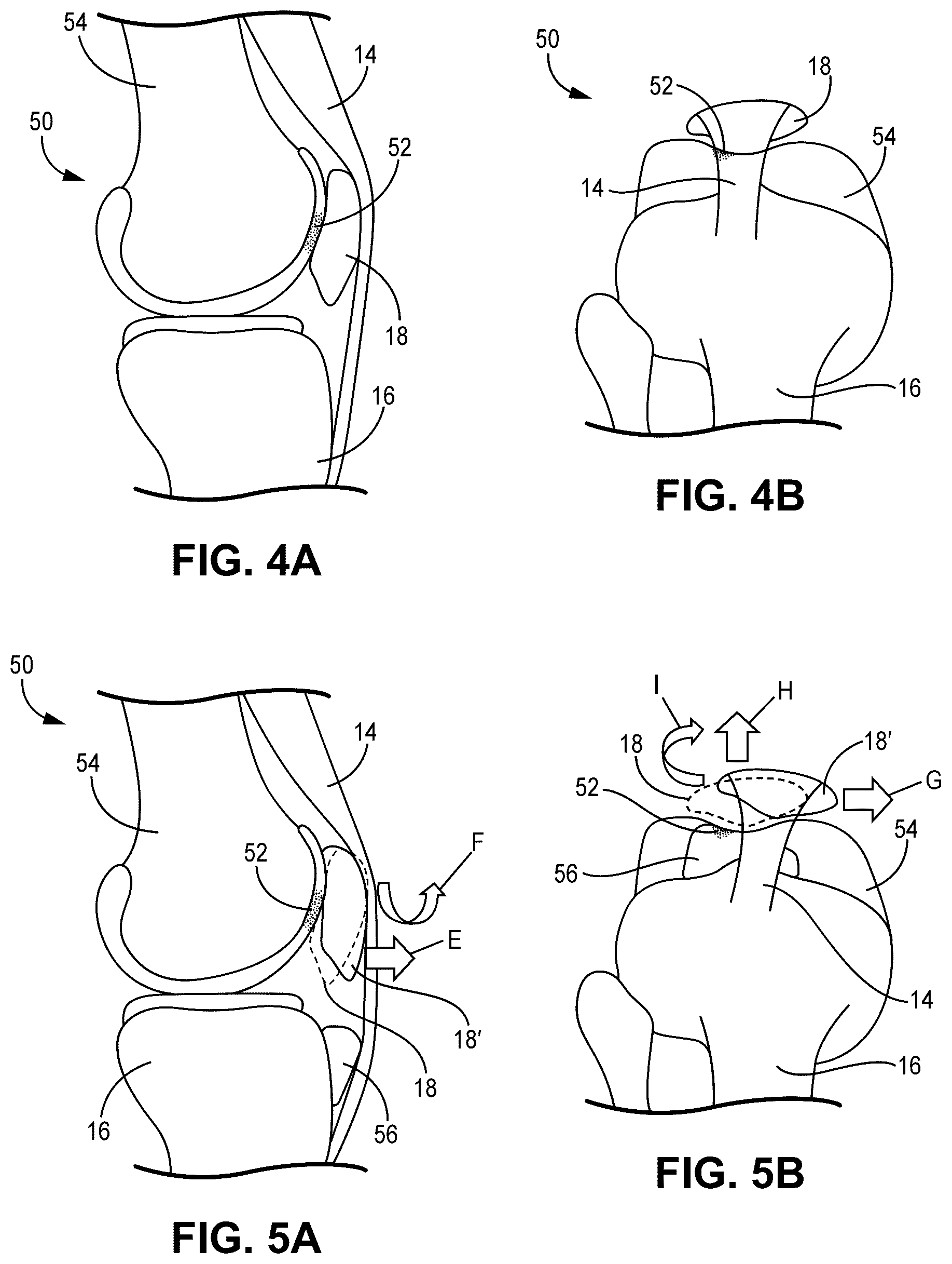 Patent US12551330 Figure 5 – Multiplanar tendon realignment implants and related systems and methods