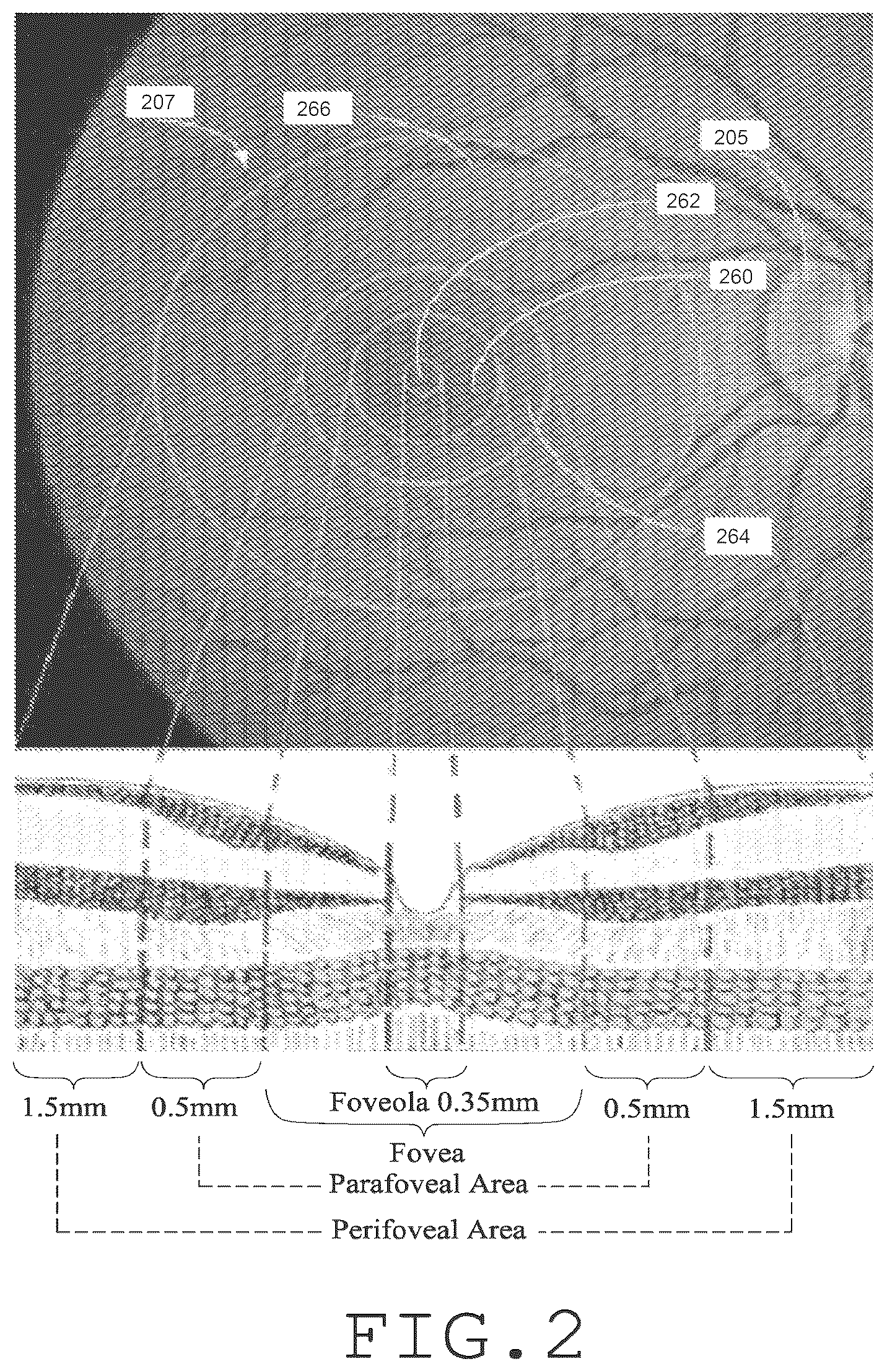 Patent US12551332 Figure 2 – Piggyback intraocular lens that improves overall vision where there is a local loss of retinal function