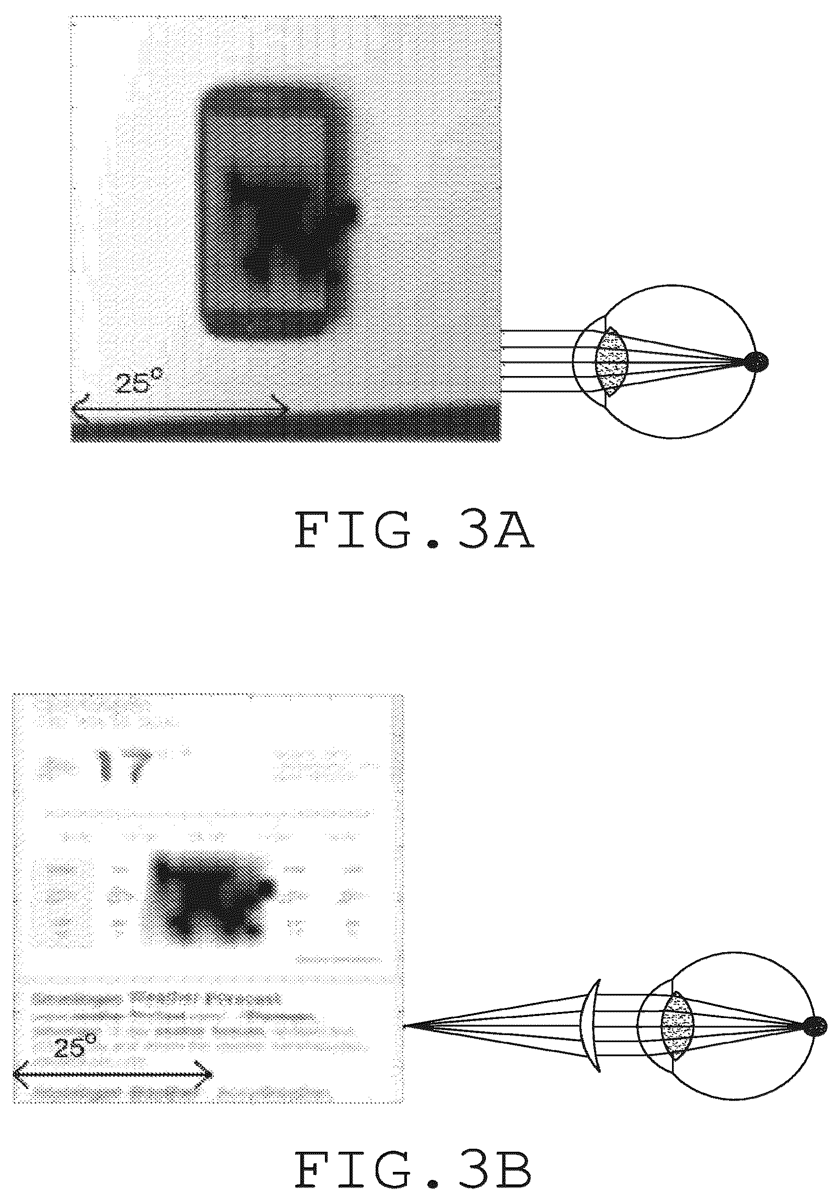 Patent US12551332 Figure 3 – Piggyback intraocular lens that improves overall vision where there is a local loss of retinal function