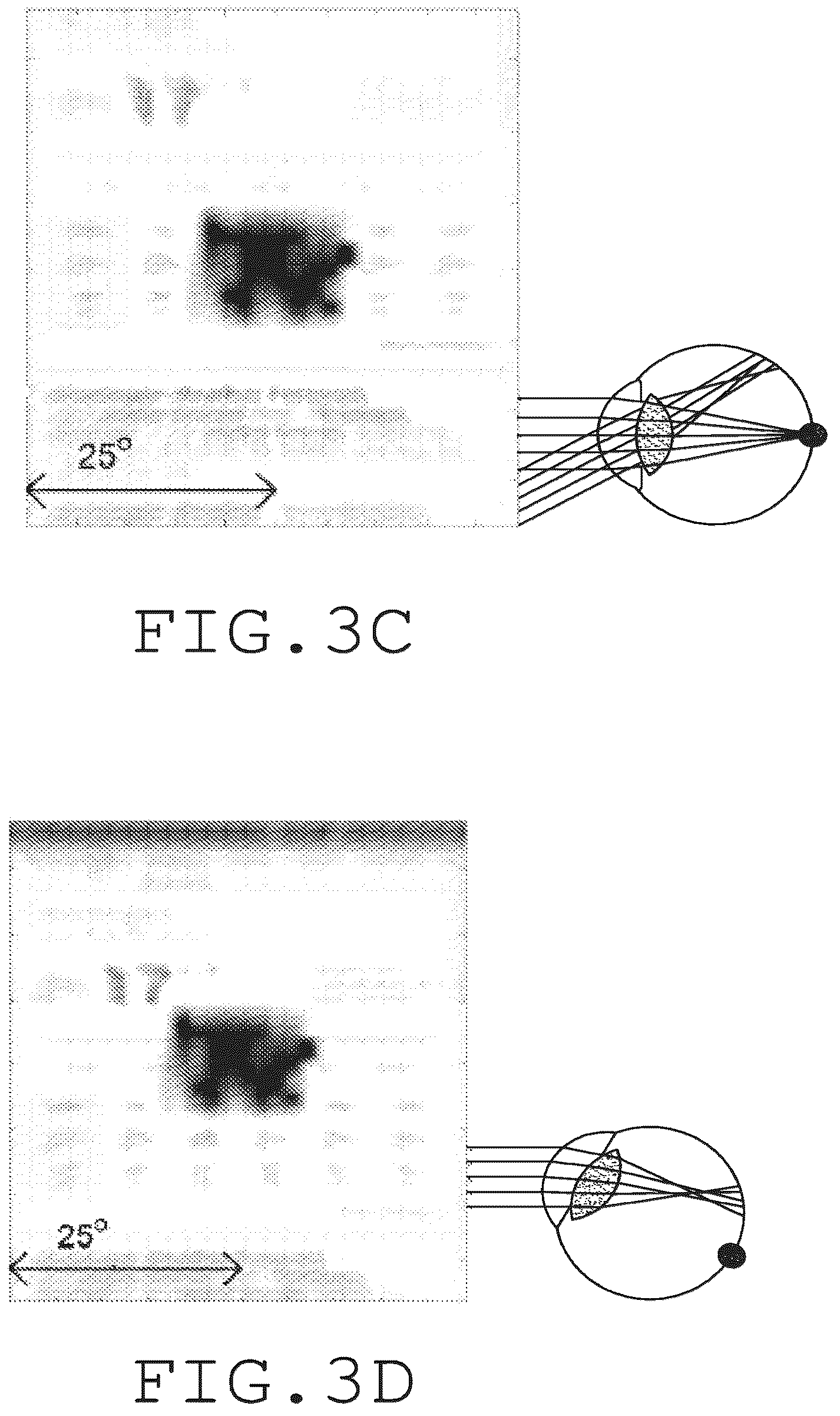 Patent US12551332 Figure 4 – Piggyback intraocular lens that improves overall vision where there is a local loss of retinal function