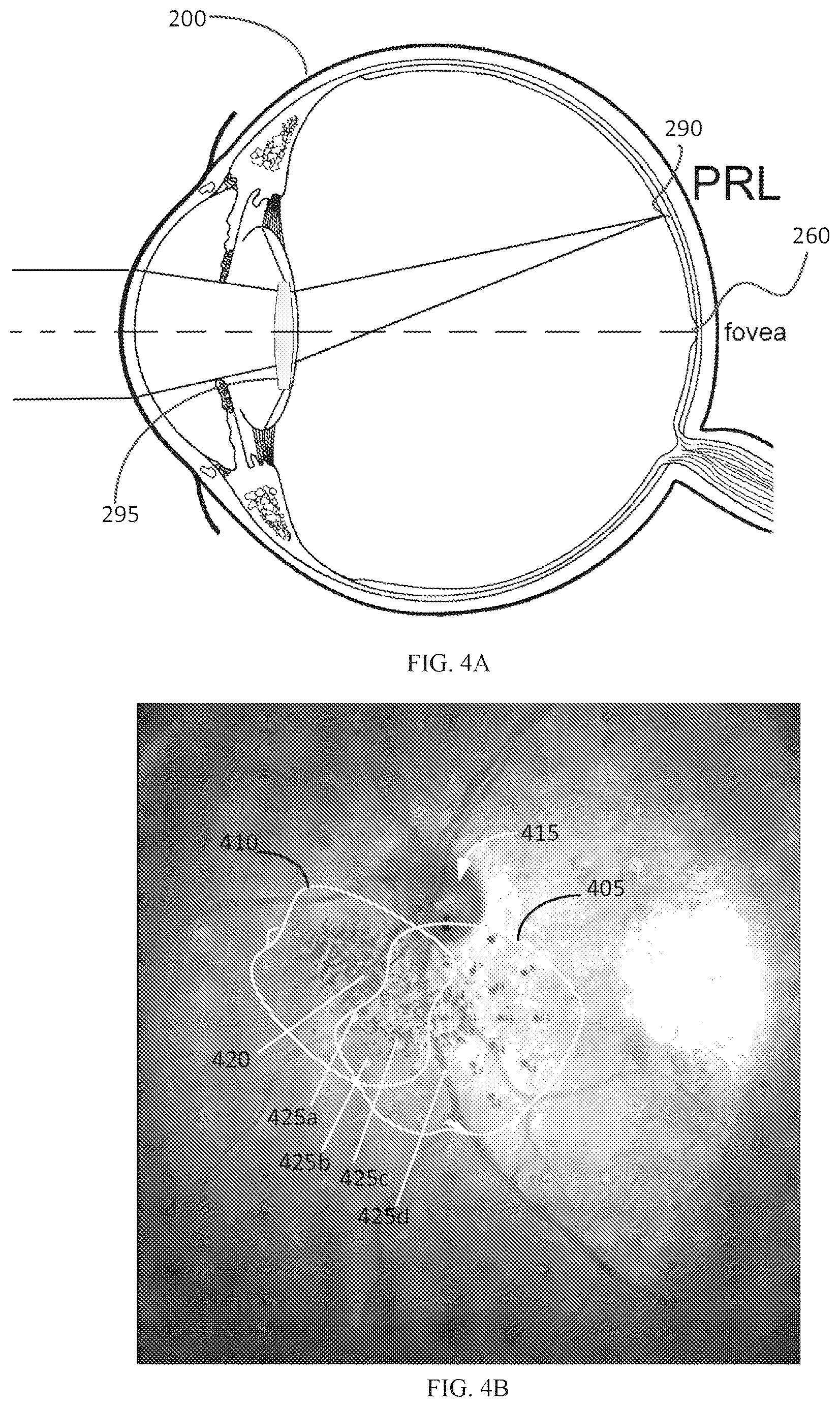 Patent US12551332 Figure 5 – Piggyback intraocular lens that improves overall vision where there is a local loss of retinal function