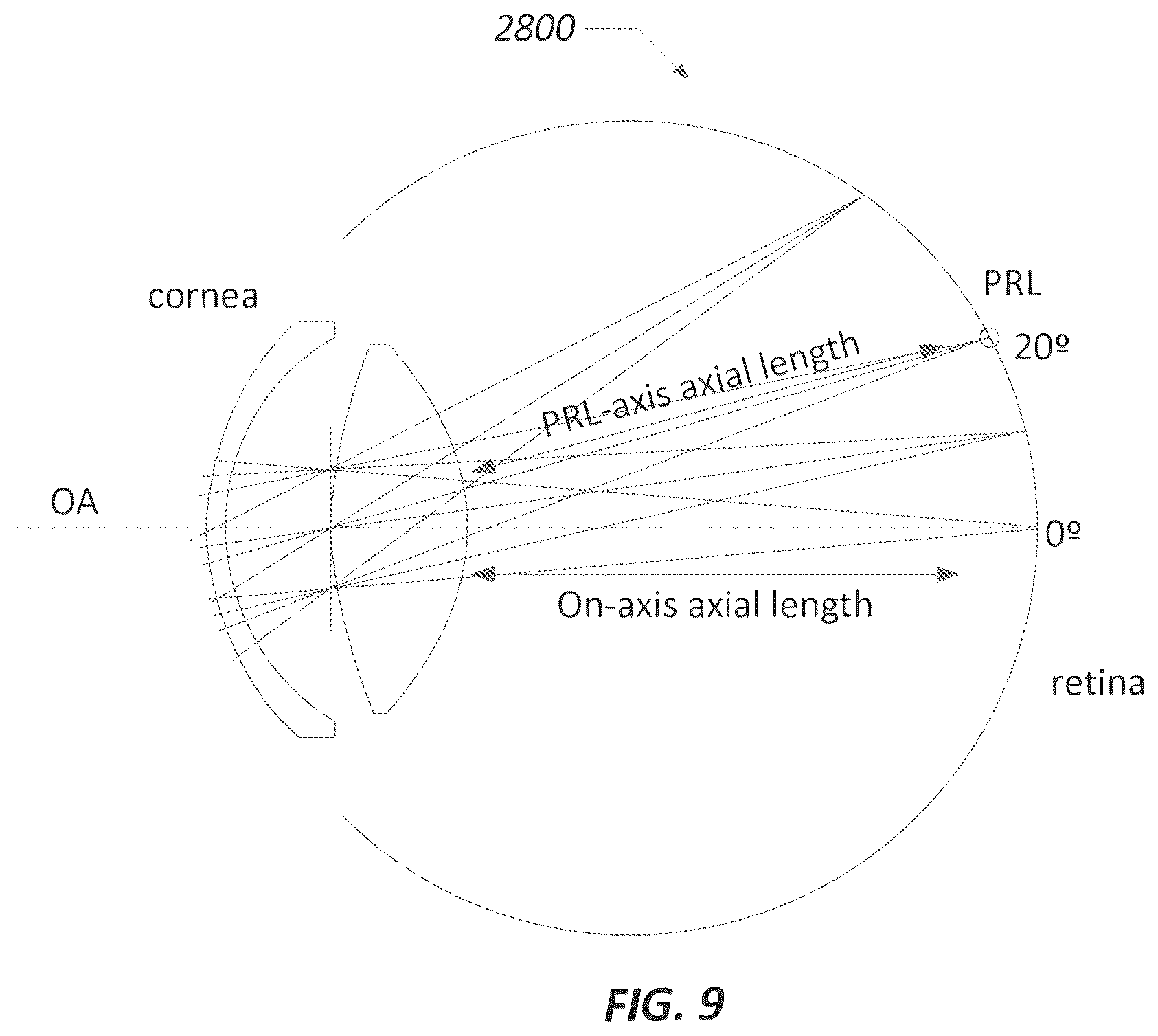 Patent US12551332 Figure 11 – Piggyback intraocular lens that improves overall vision where there is a local loss of retinal function