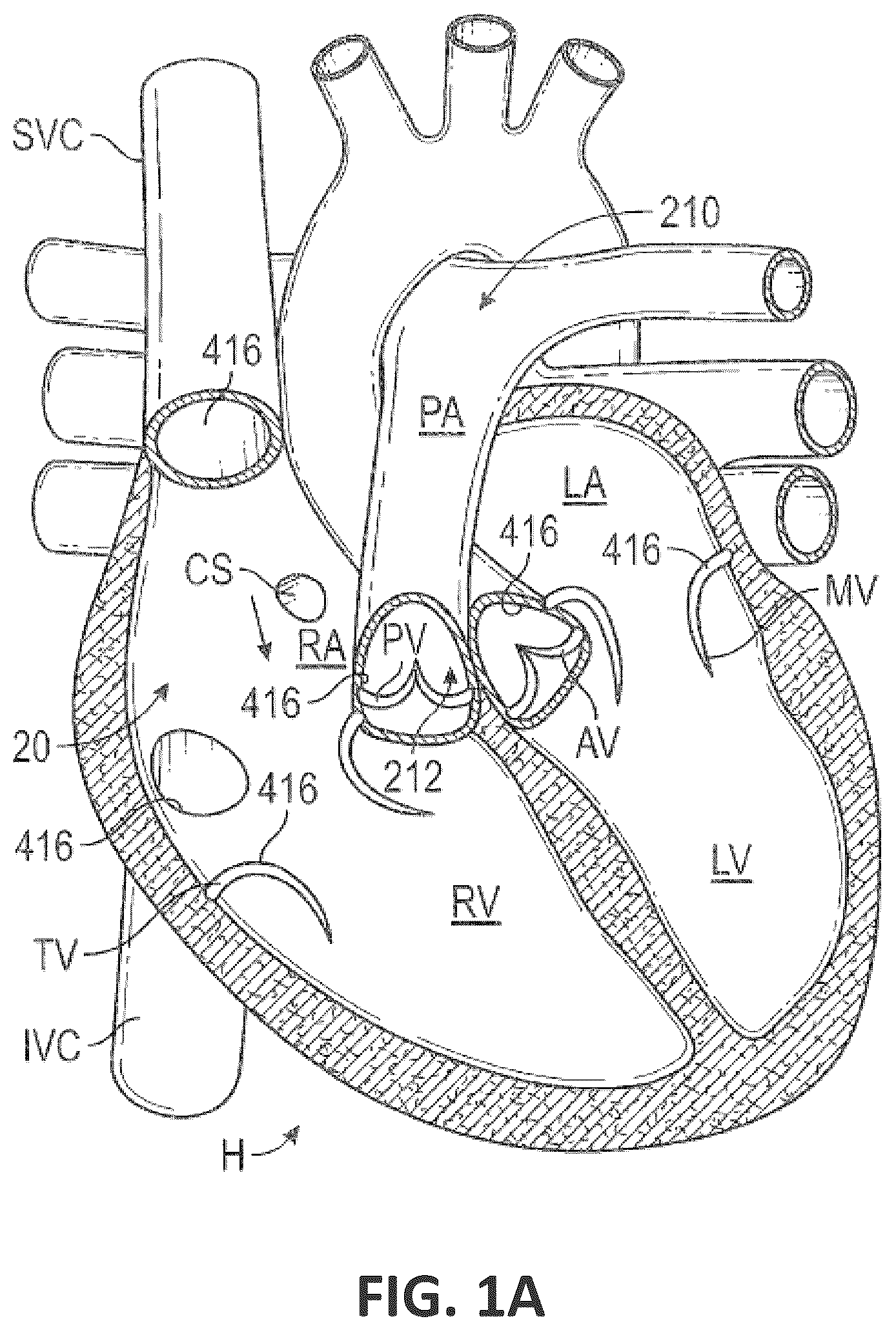 Patent US12551338 Figure 1 – Transcatheter pulmonic regenerative valve