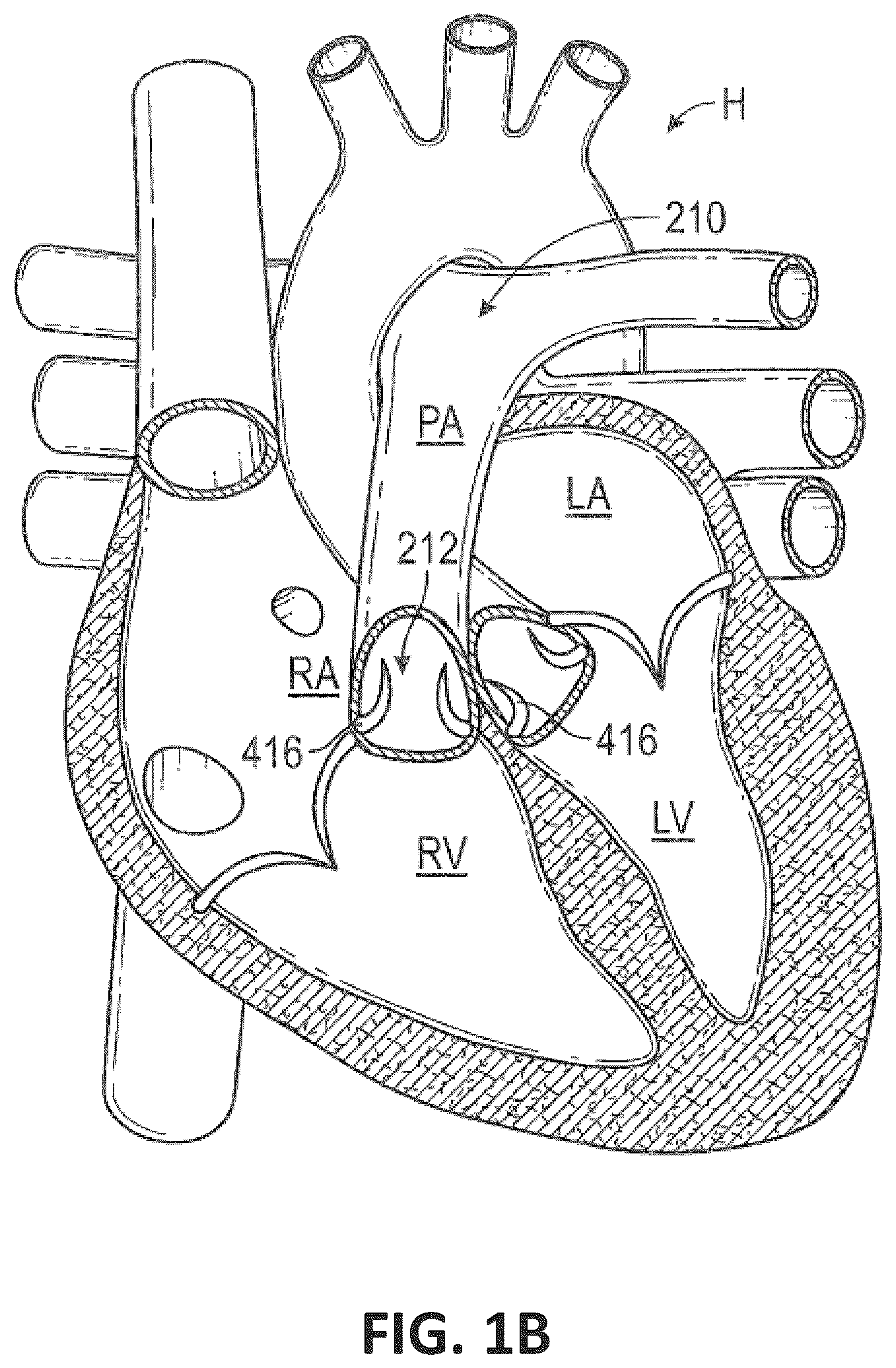 Patent US12551338 Figure 2 – Transcatheter pulmonic regenerative valve