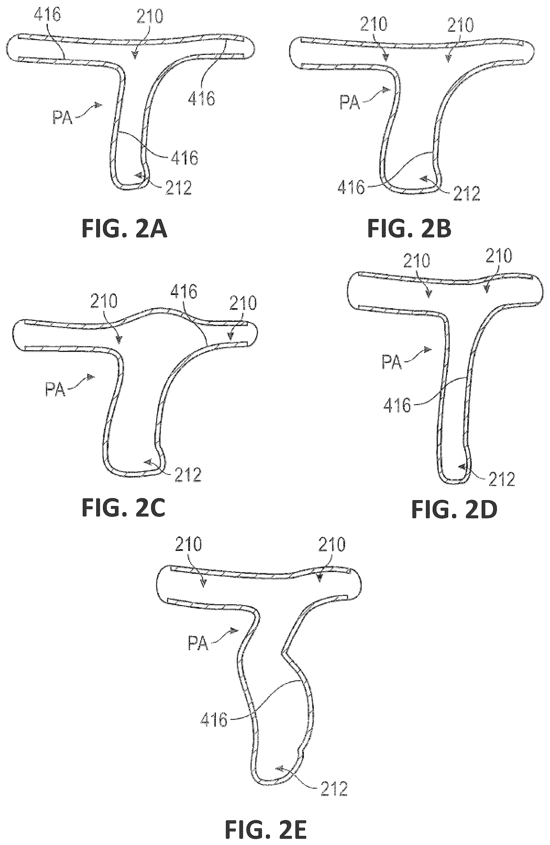 Patent US12551338 Figure 3 – Transcatheter pulmonic regenerative valve