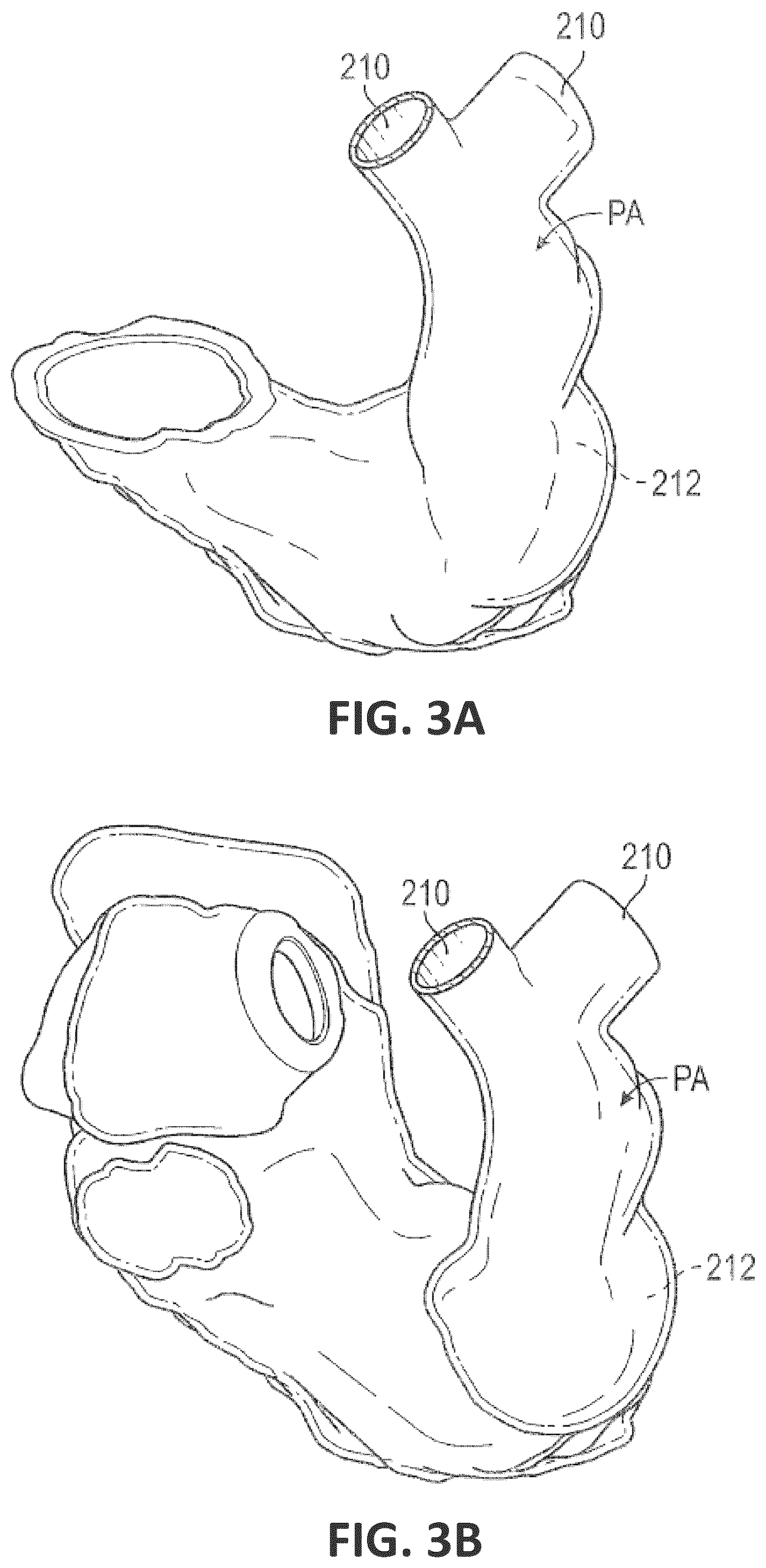 Patent US12551338 Figure 4 – Transcatheter pulmonic regenerative valve