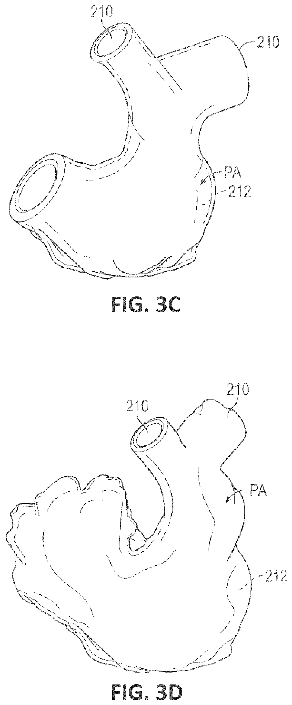 Patent US12551338 Figure 5 – Transcatheter pulmonic regenerative valve
