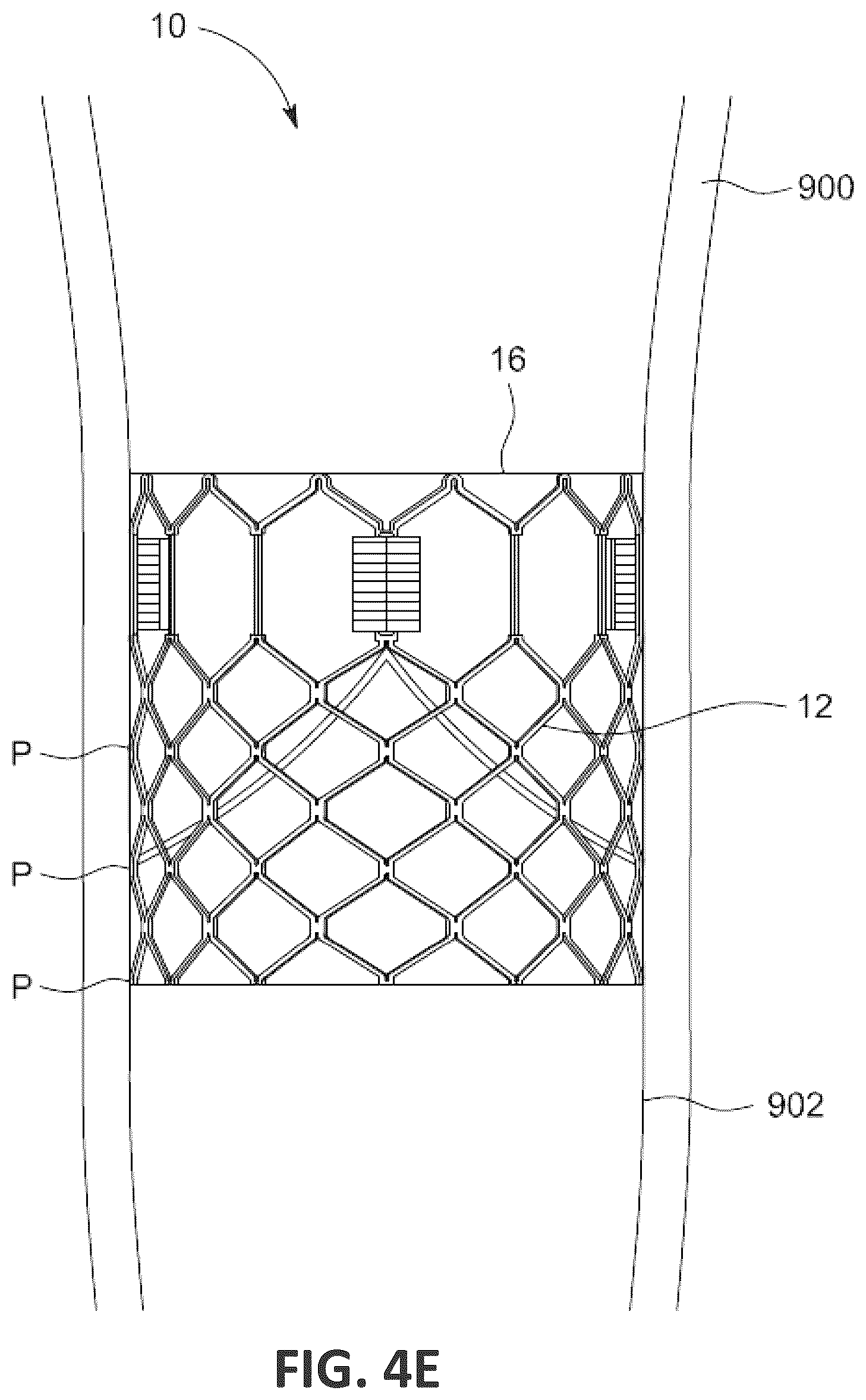 Patent US12551338 Figure 8 – Transcatheter pulmonic regenerative valve