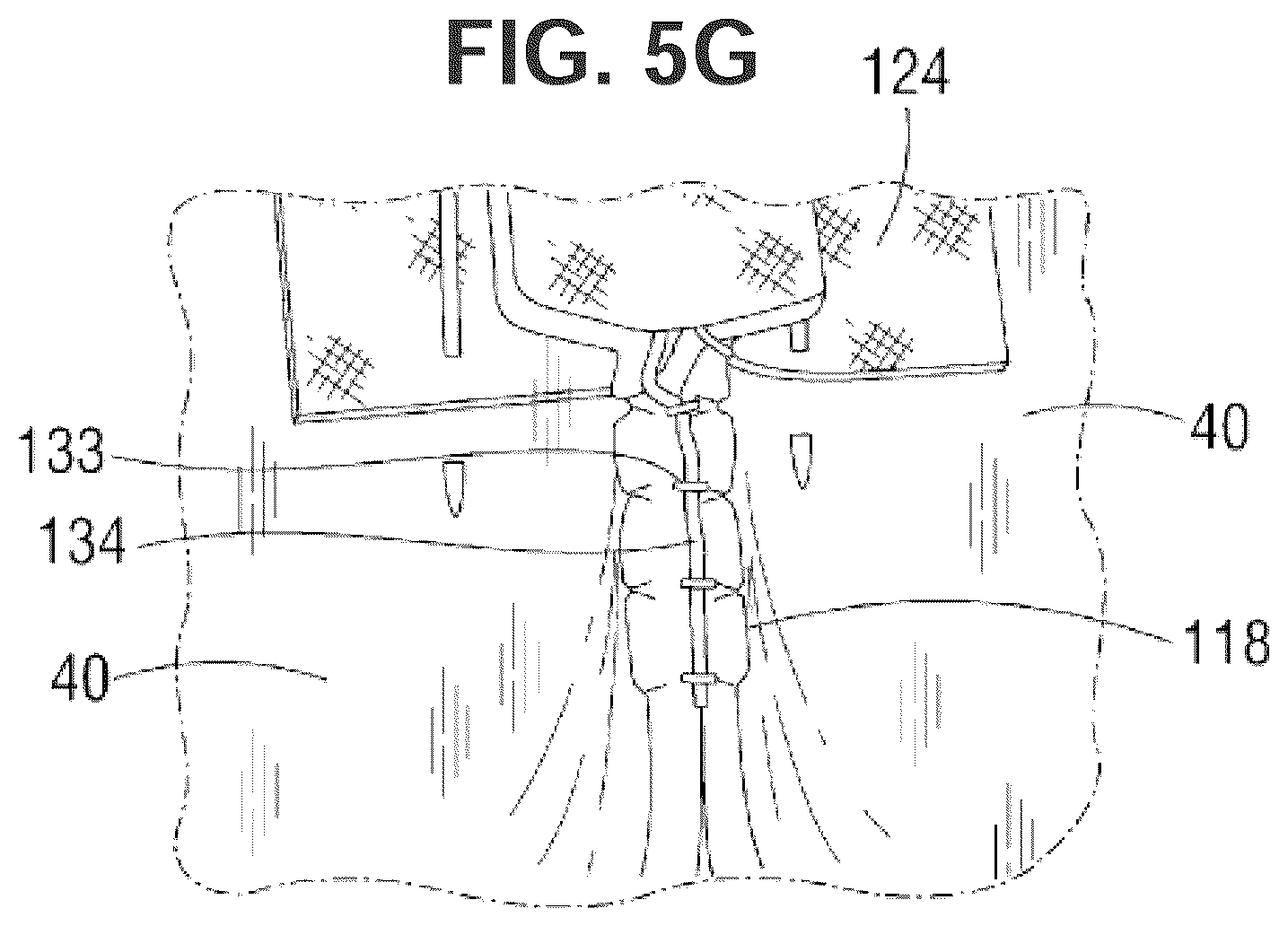 Patent US12551338 Figure 11 – Transcatheter pulmonic regenerative valve