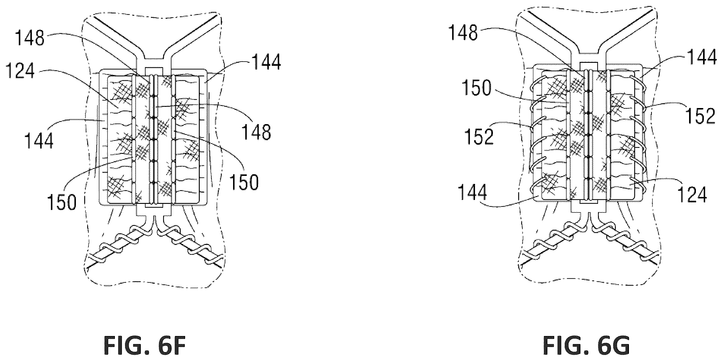 Patent US12551338 Figure 14 – Transcatheter pulmonic regenerative valve