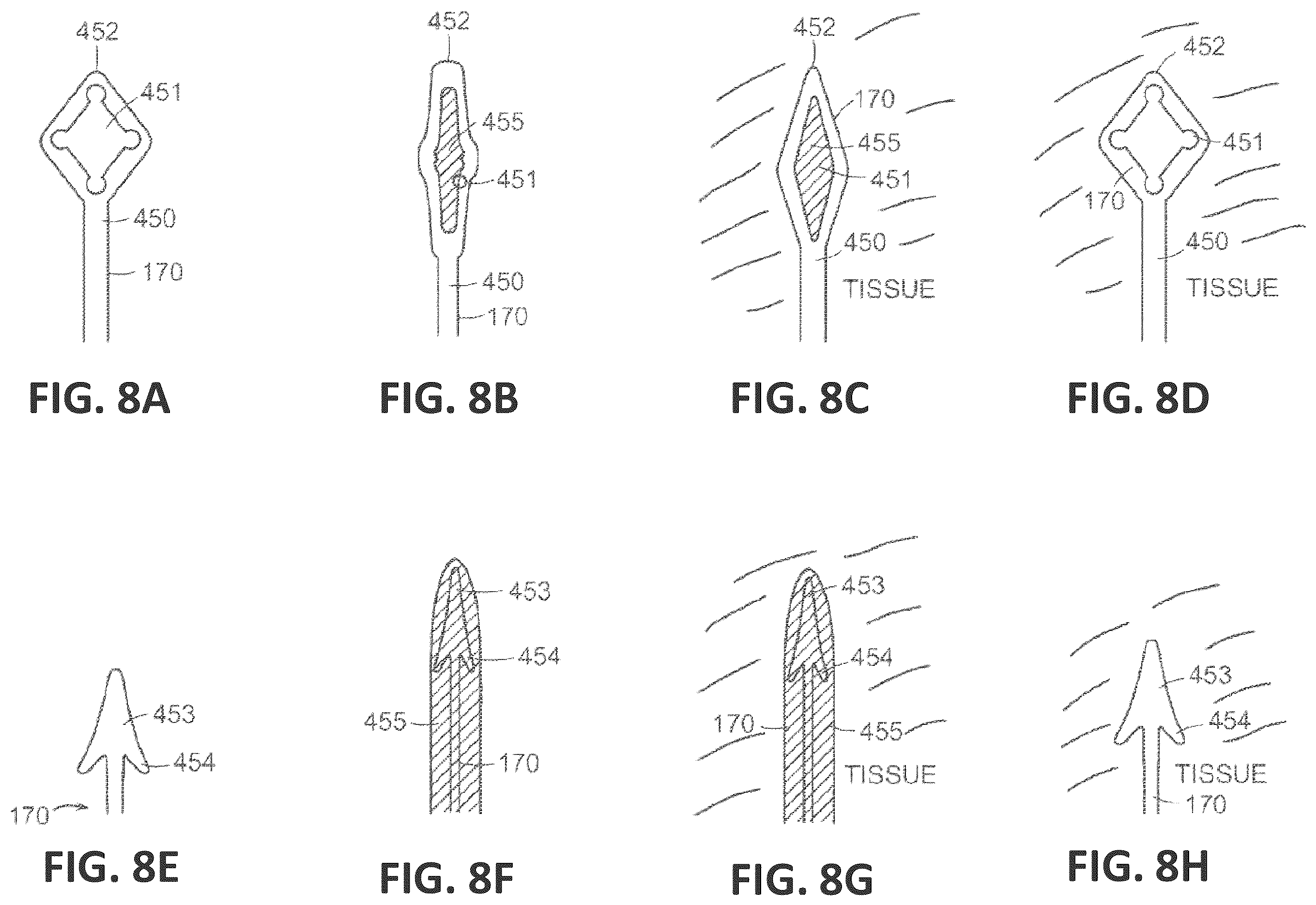 Patent US12551338 Figure 18 – Transcatheter pulmonic regenerative valve