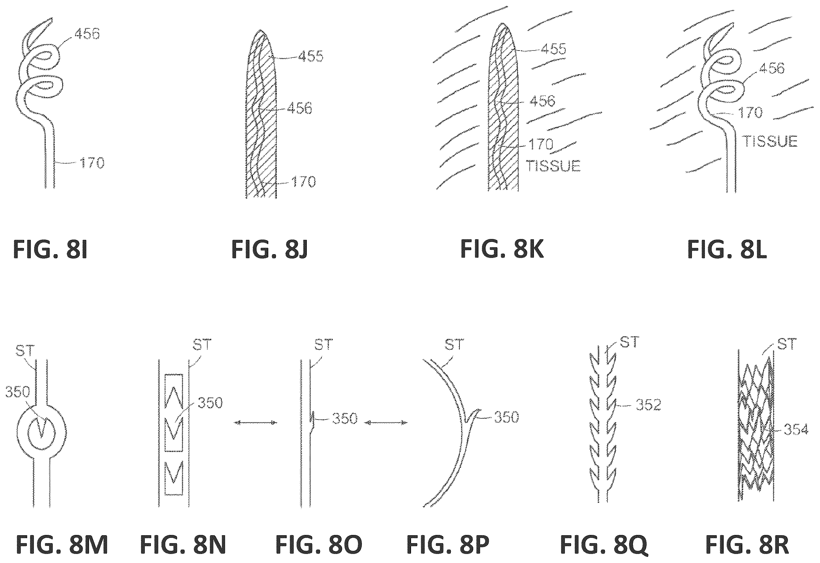 Patent US12551338 Figure 19 – Transcatheter pulmonic regenerative valve