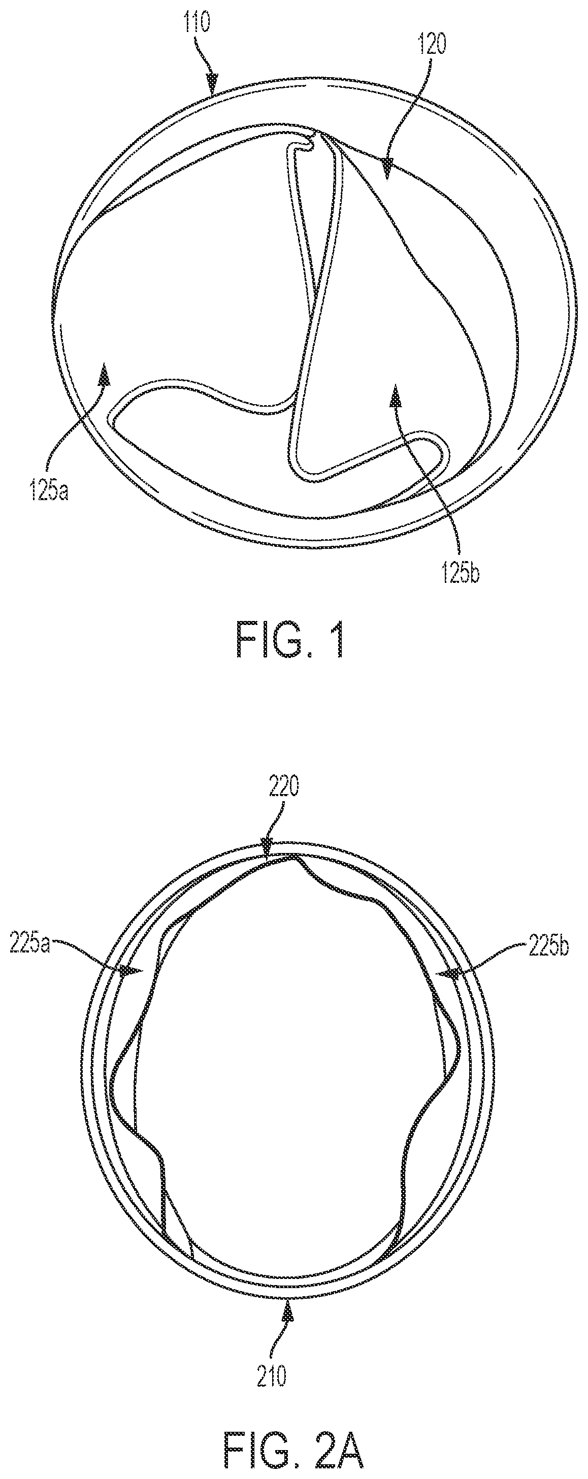 Patent US12551339 Figure 1 – Expandable implantable conduit