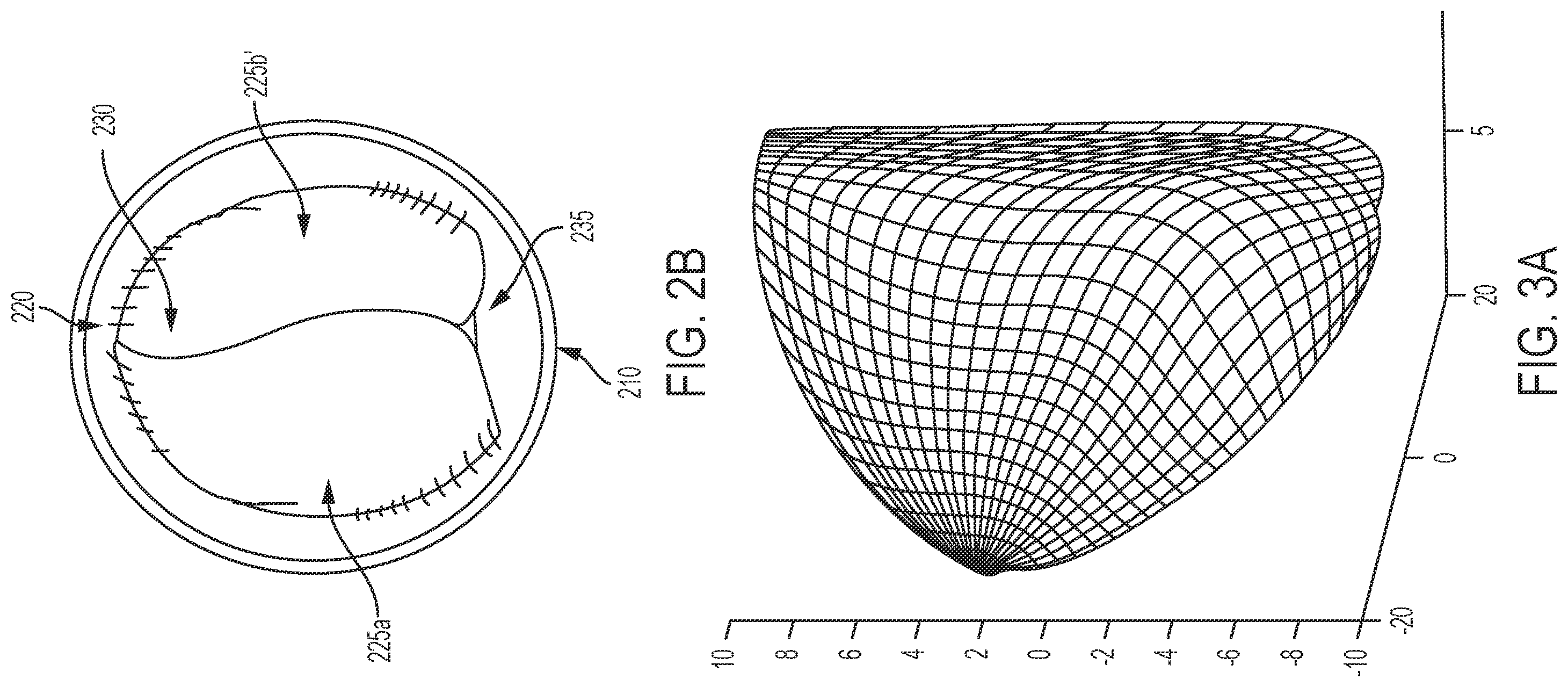 Patent US12551339 Figure 2 – Expandable implantable conduit