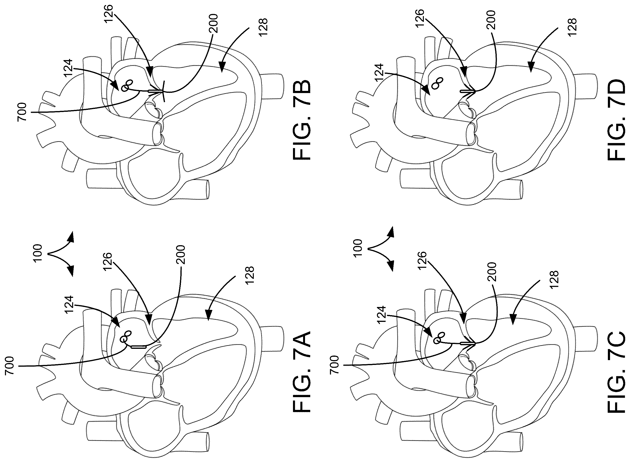 Patent US12551341 Figure 5 – Heart valve clip