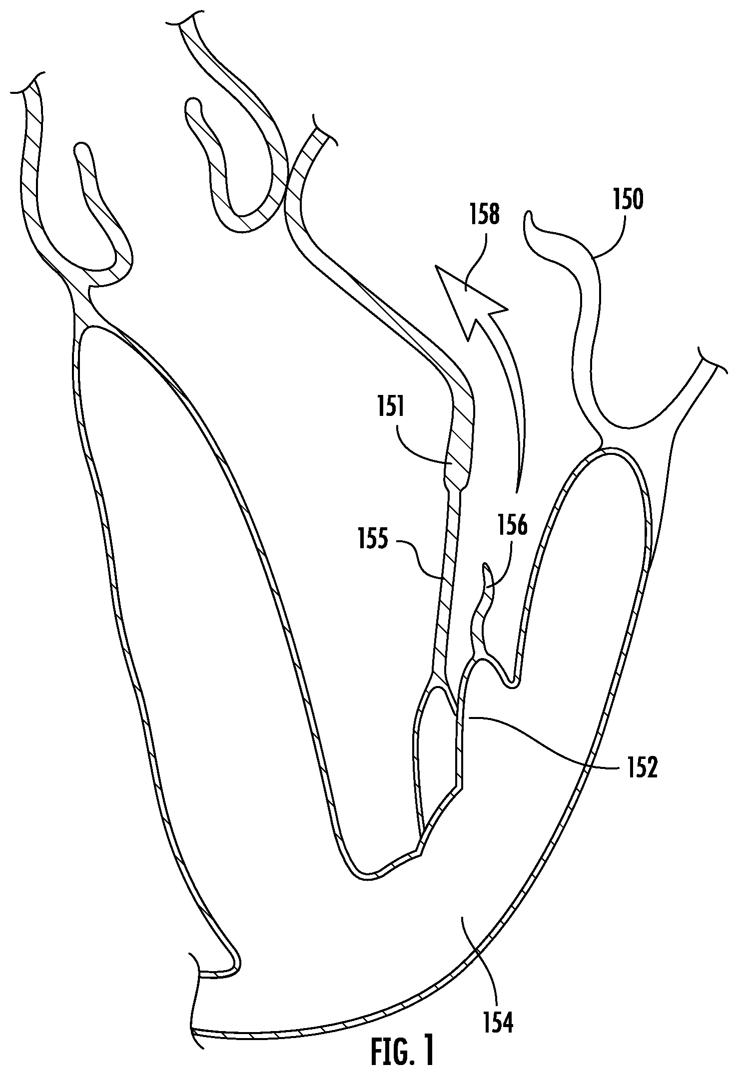 Patent US12551342 Figure 1 – Devices, systems, and methods for adjustably tensioning an artificial chordae tendineae between a leaflet and a papillary muscle or heart wall