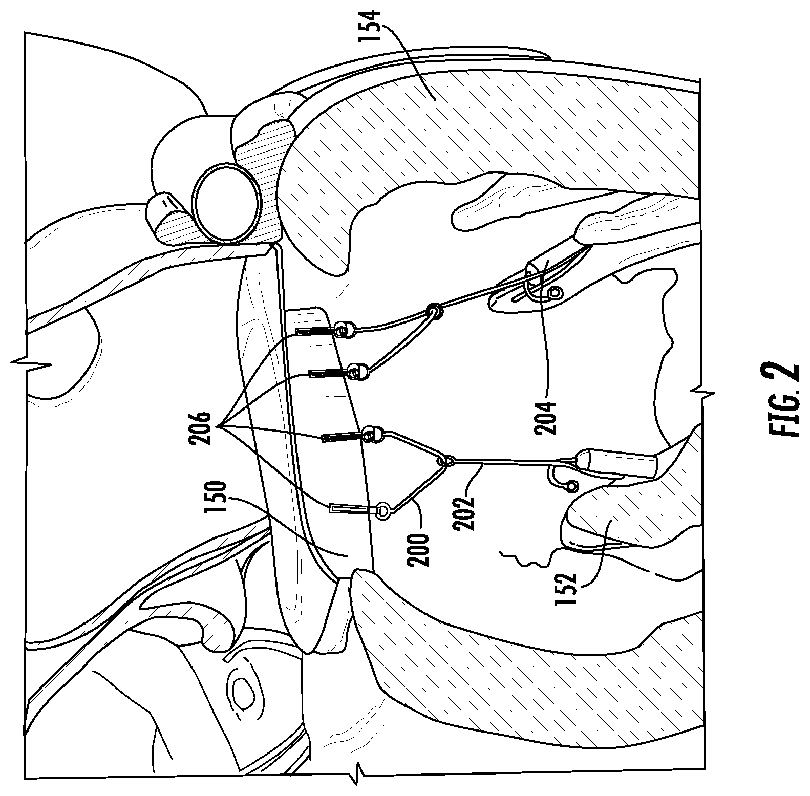 Patent US12551342 Figure 2 – Devices, systems, and methods for adjustably tensioning an artificial chordae tendineae between a leaflet and a papillary muscle or heart wall
