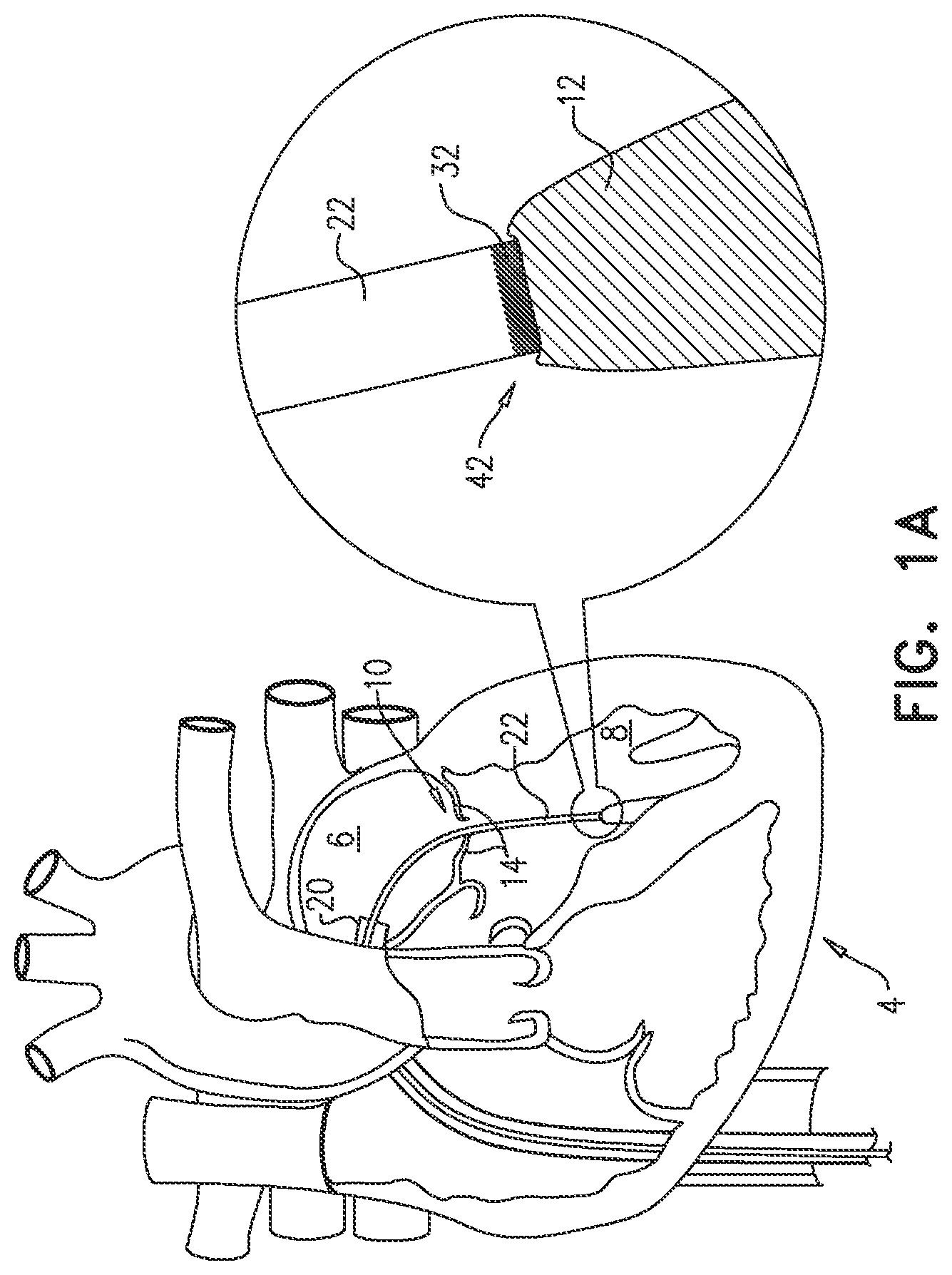 Patent US12551343 — Techniques for fluoroscopic cardiac measurement — Figure 1