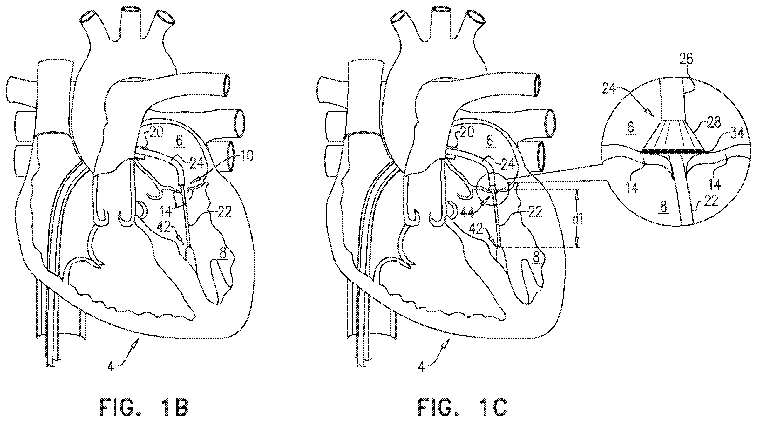 Patent US12551343 Figure 2 – Techniques for fluoroscopic cardiac measurement