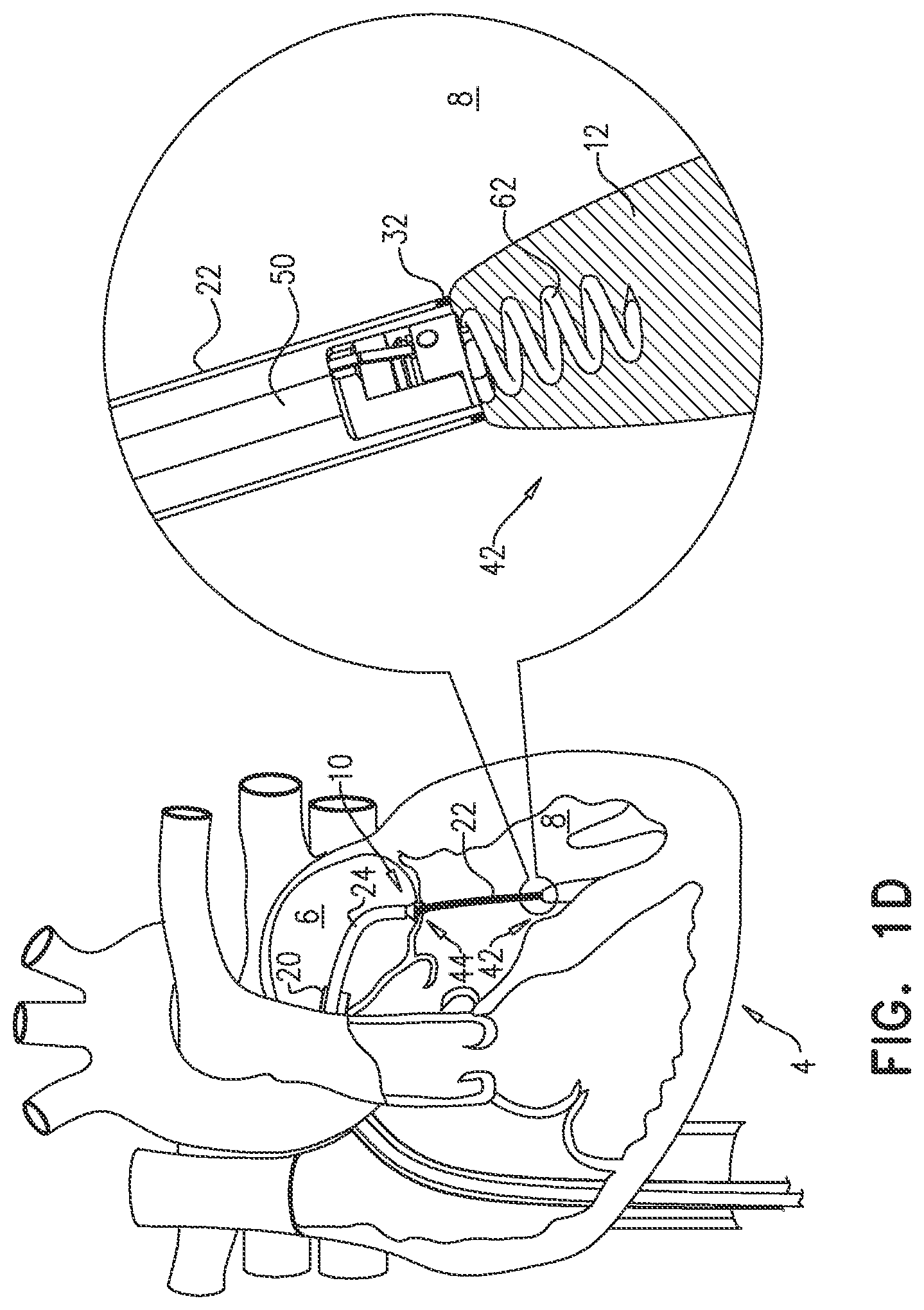 Patent US12551343 Figure 3 – Techniques for fluoroscopic cardiac measurement