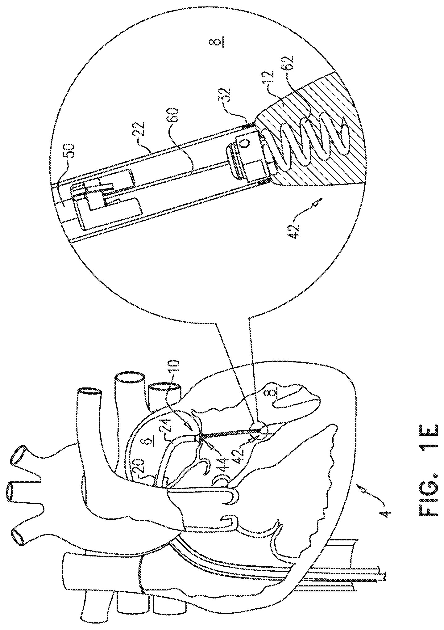 Patent US12551343 Figure 4 – Techniques for fluoroscopic cardiac measurement