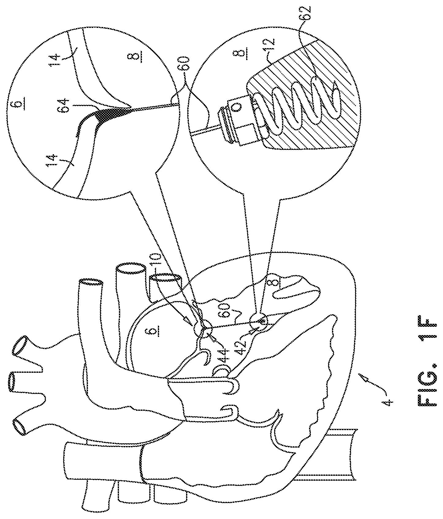 Patent US12551343 Figure 5 – Techniques for fluoroscopic cardiac measurement