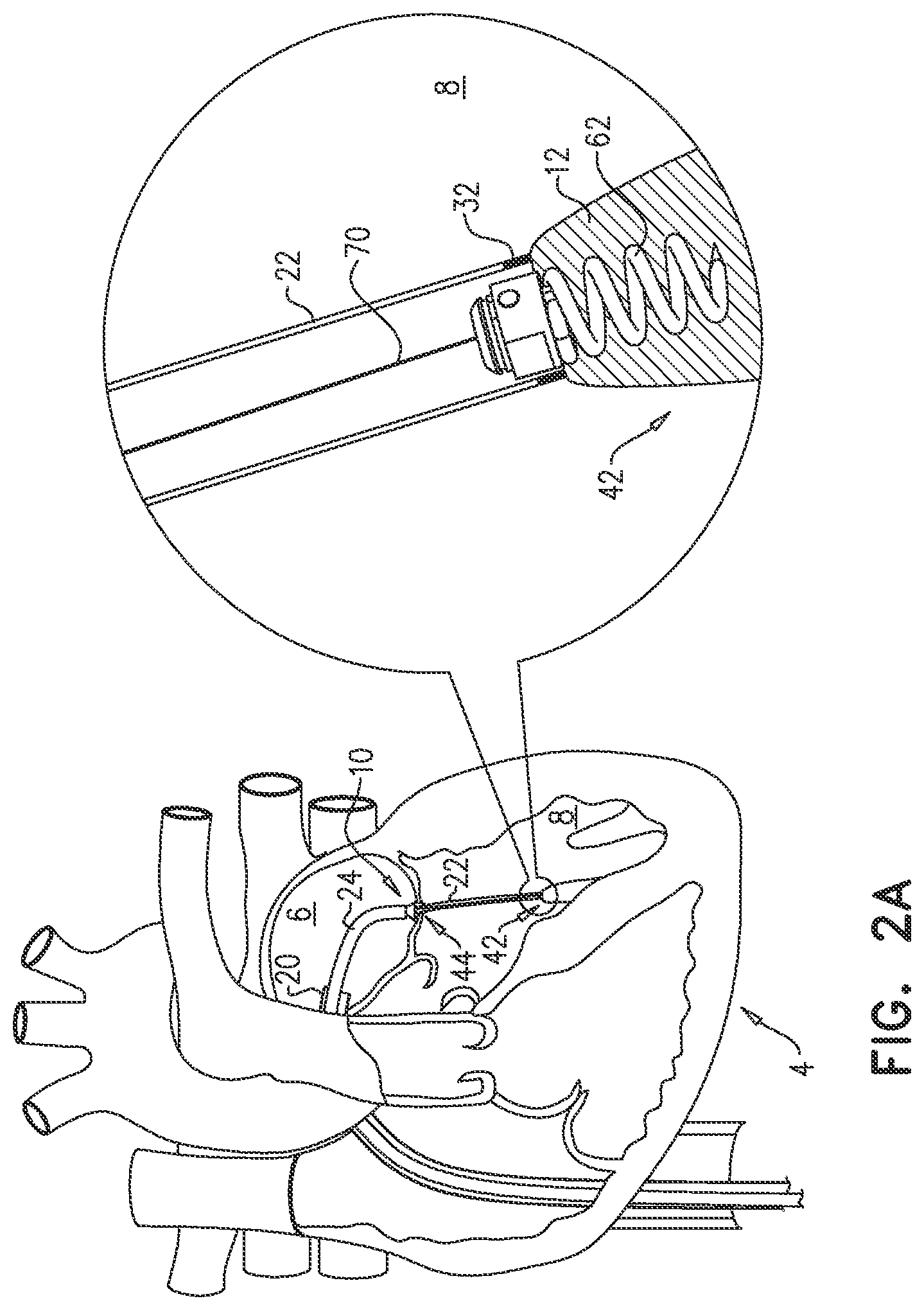 Patent US12551343 Figure 6 – Techniques for fluoroscopic cardiac measurement