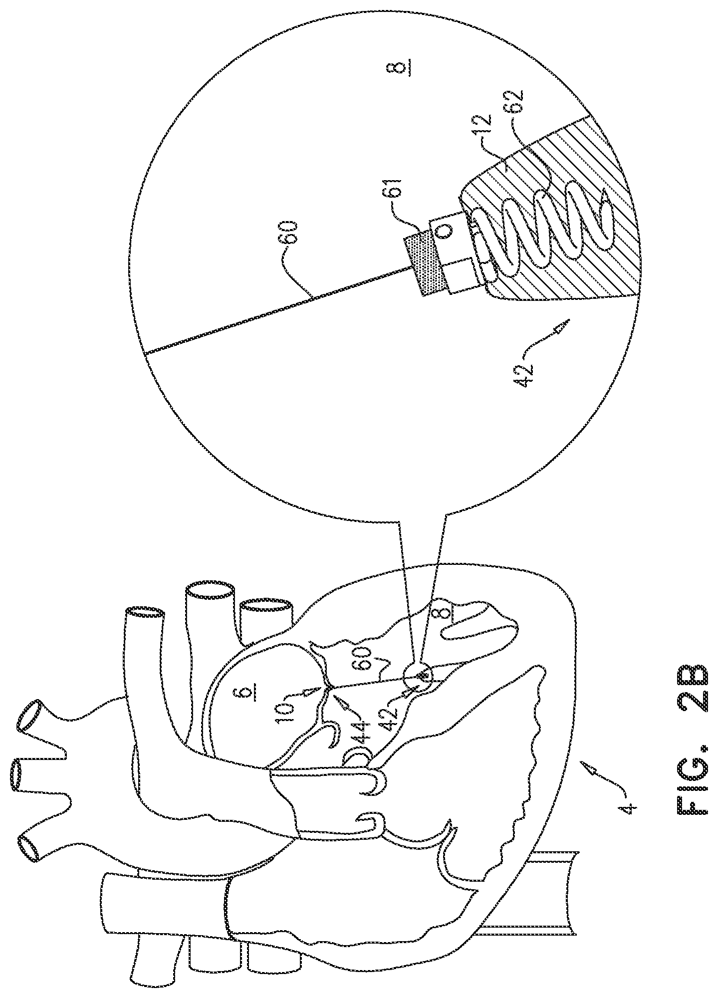 Patent US12551343 Figure 7 – Techniques for fluoroscopic cardiac measurement