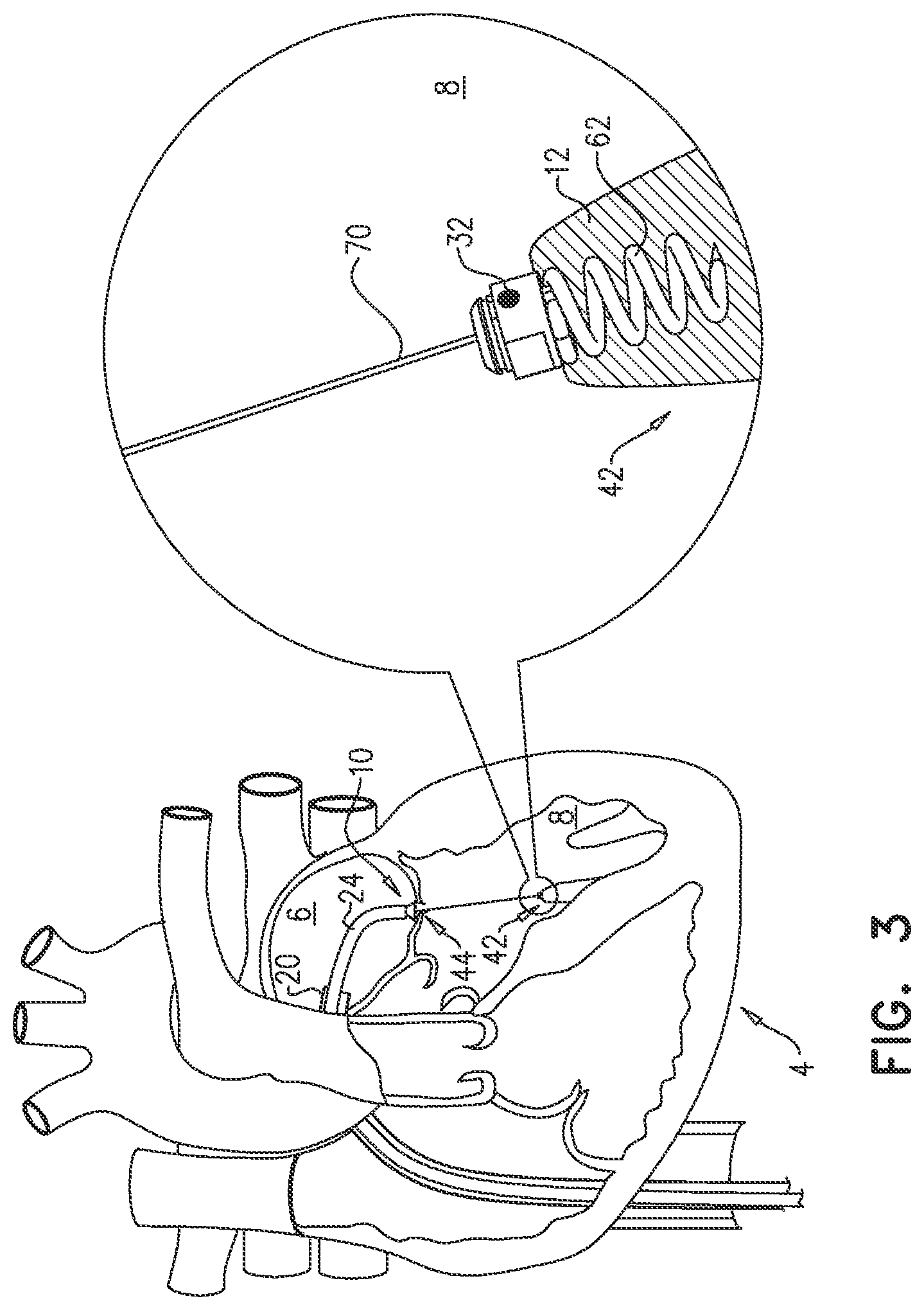 Patent US12551343 Figure 8 – Techniques for fluoroscopic cardiac measurement