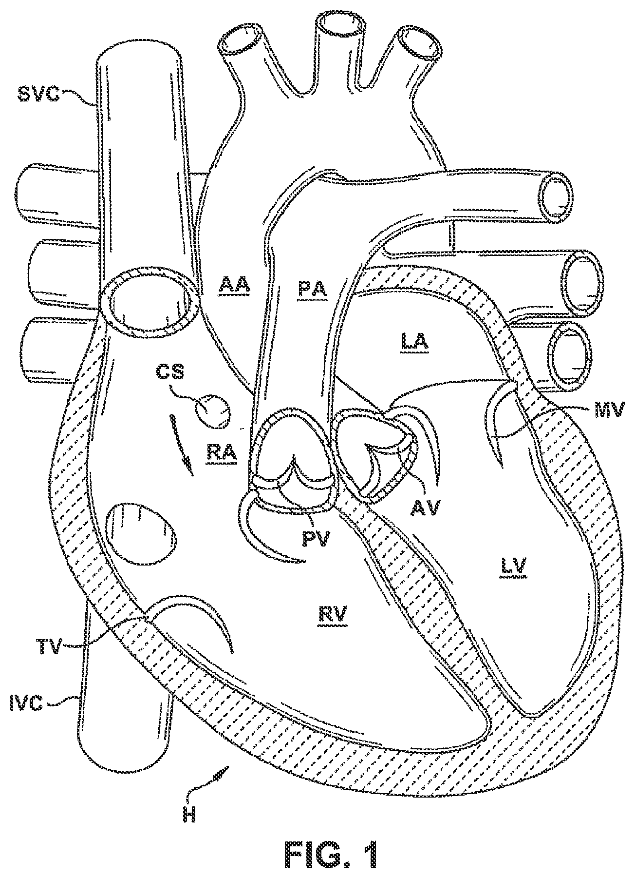 Patent US12551344 — Heart valve sealing devices and delivery devices therefor — Figure 1