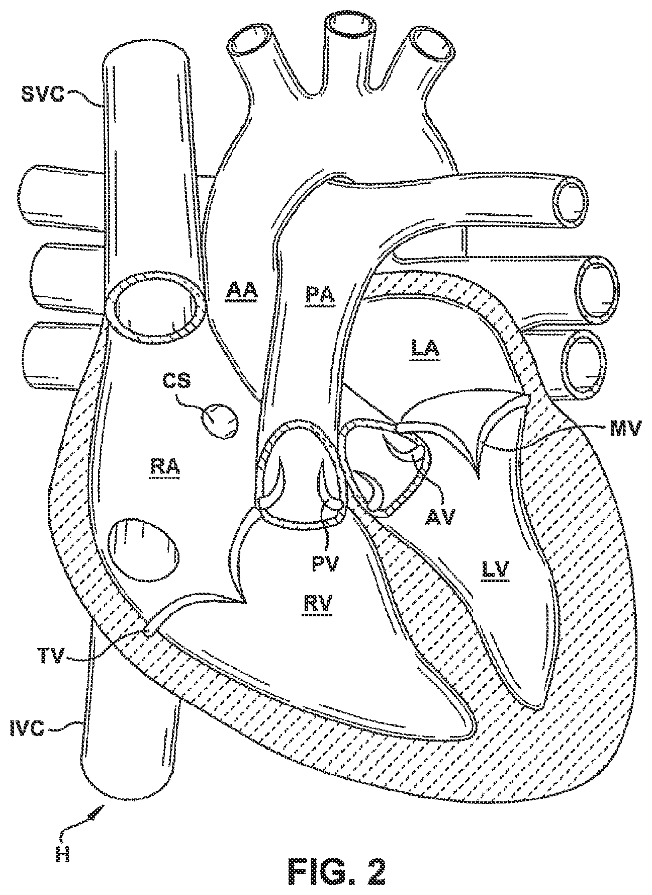 Patent US12551344 Figure 2 – Heart valve sealing devices and delivery devices therefor