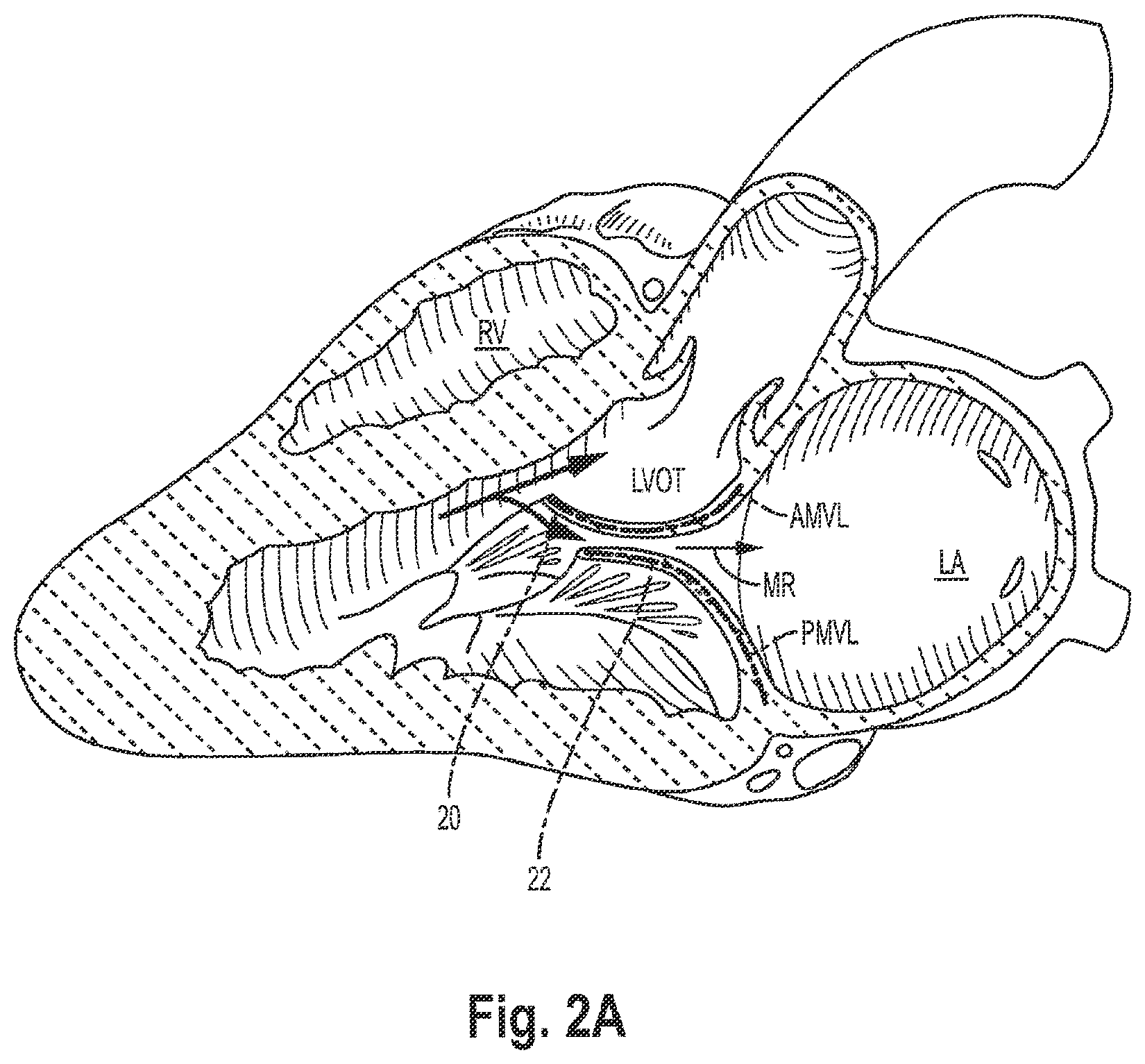 Patent US12551344 Figure 3 – Heart valve sealing devices and delivery devices therefor